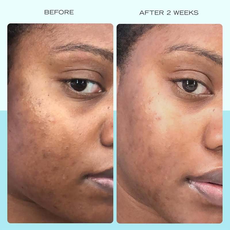 First Aid Beauty Dark Spot Serum - Niacinamide for Hyperpigmentation & Discoloration | 1 oz