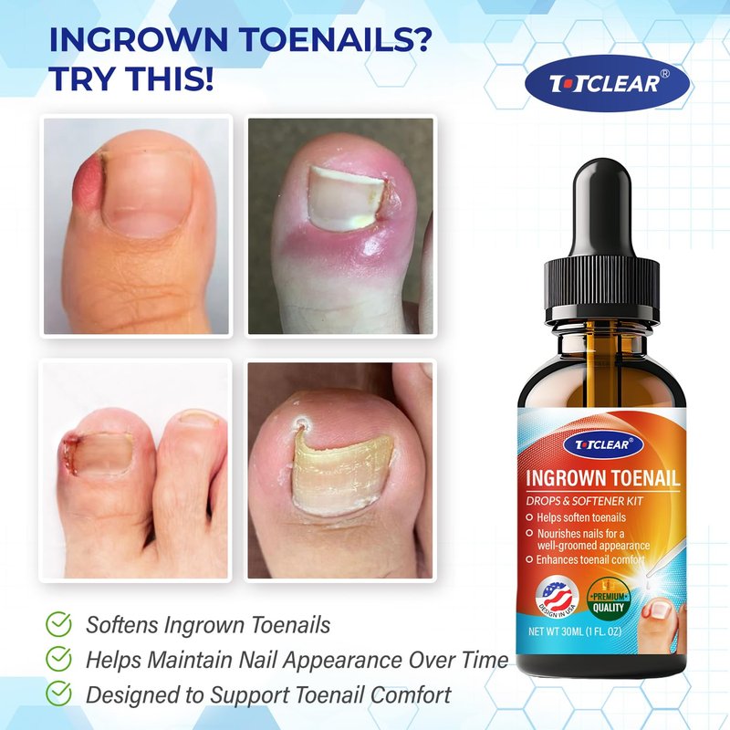 Ingrown Toenail Relief Tool - Effective Ingrown Toenail Removal Kit for Men & Women | 30ml