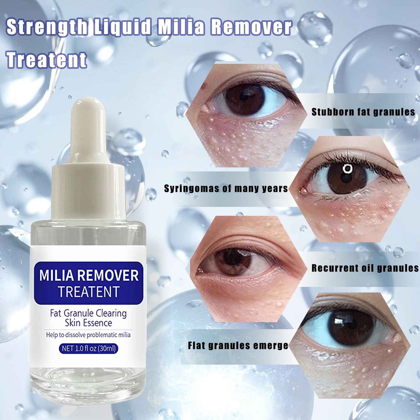 Dermfree Milia Remover Treatment, Milia Spot Treatment with Salicylic Acid Milia Acne Serum Clearing Skin Essence(30ML)
