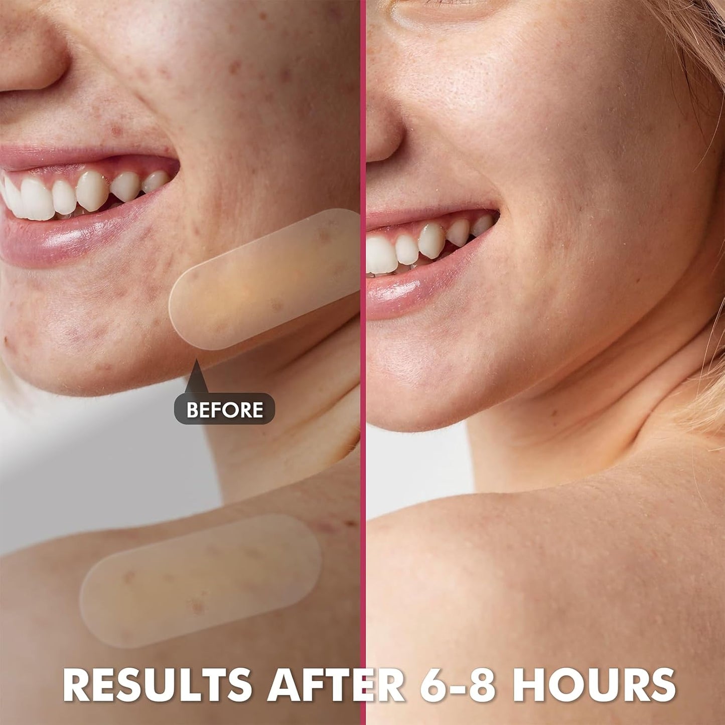 Albatross Health New England Invisible Pimple Patches for face, plain Hydrocolloid Acne Patches, HSA FSA eligible, Spot Dots Cover, Zit Blemish Patch, 2 Sizes 180 Counts