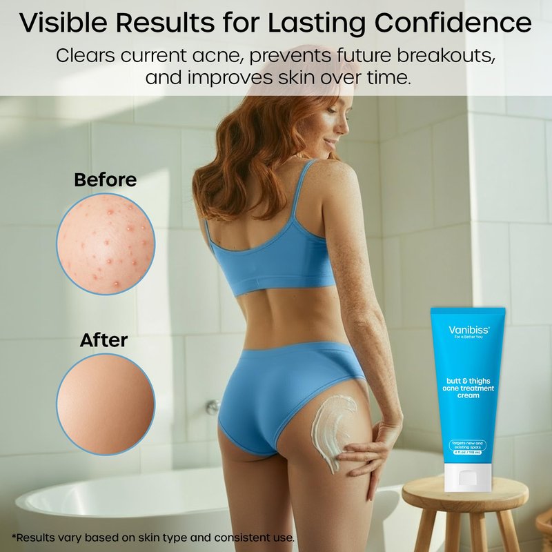 Vanibiss Butt & Thighs Acne Clearing Treatment - Back Acne Treatment - Body Acne Treatment Cream with 2% Salicylic Acid for Women - 4oz