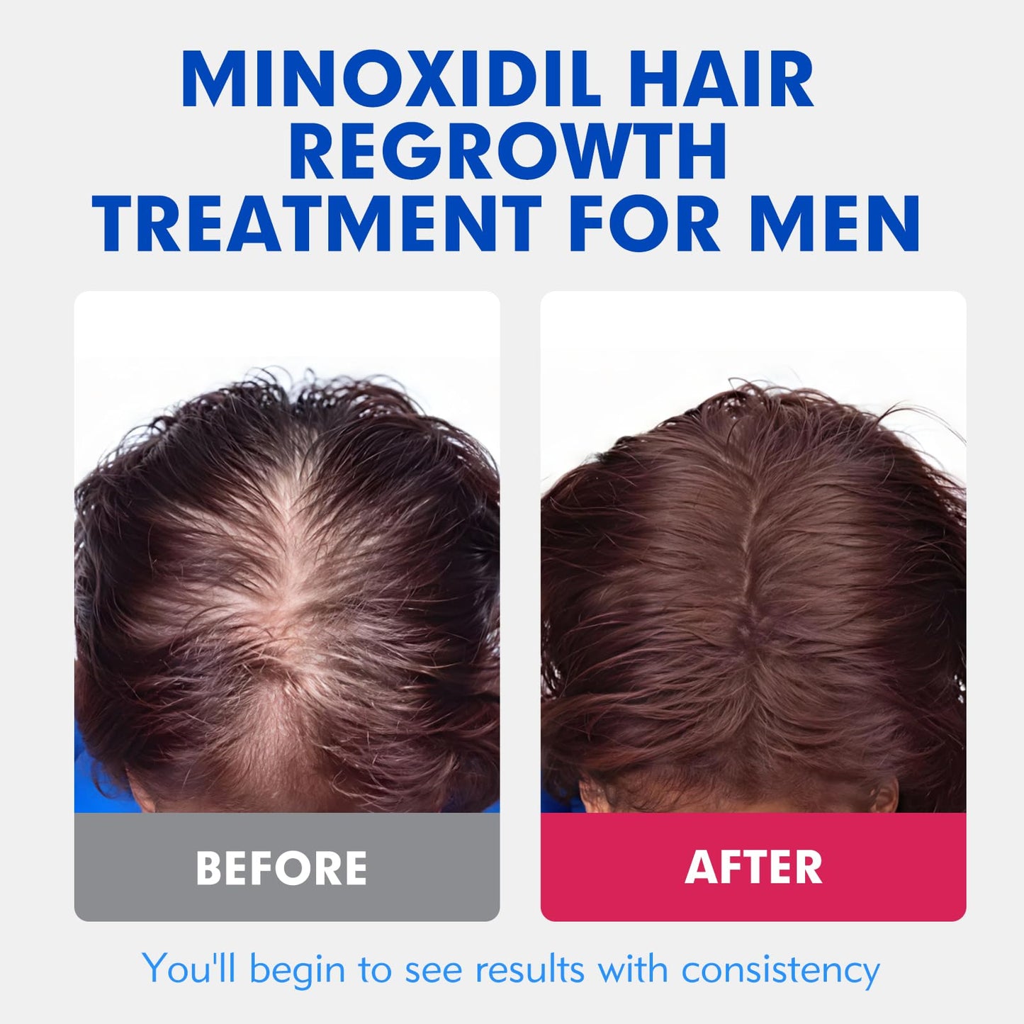 5% Minoxidil for Men Hair Regrowth Treatment, Extra Strength Topical Solution for Thinning Hair & Balding, Beard Growth Enhancer, Non-Greasy Fast-Absorbing Formula, 4-Pack (240ml) 4-Month Supply