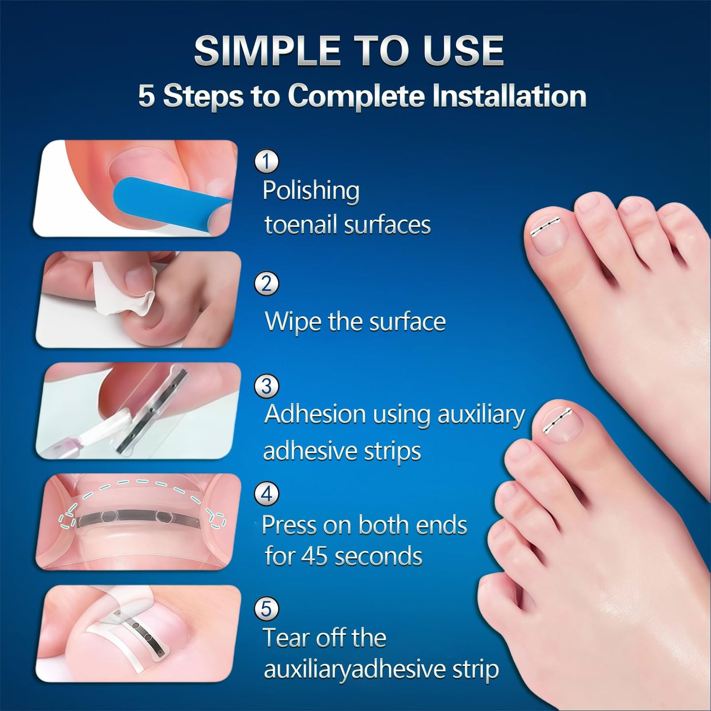 Titanium Alloy Ingrown Toenail Treatment for Curly Ingrown Toenail Corrector - Home Use arc Ingrown Toenail Removal Kit,Men, Women and Curled Toenail Corrector