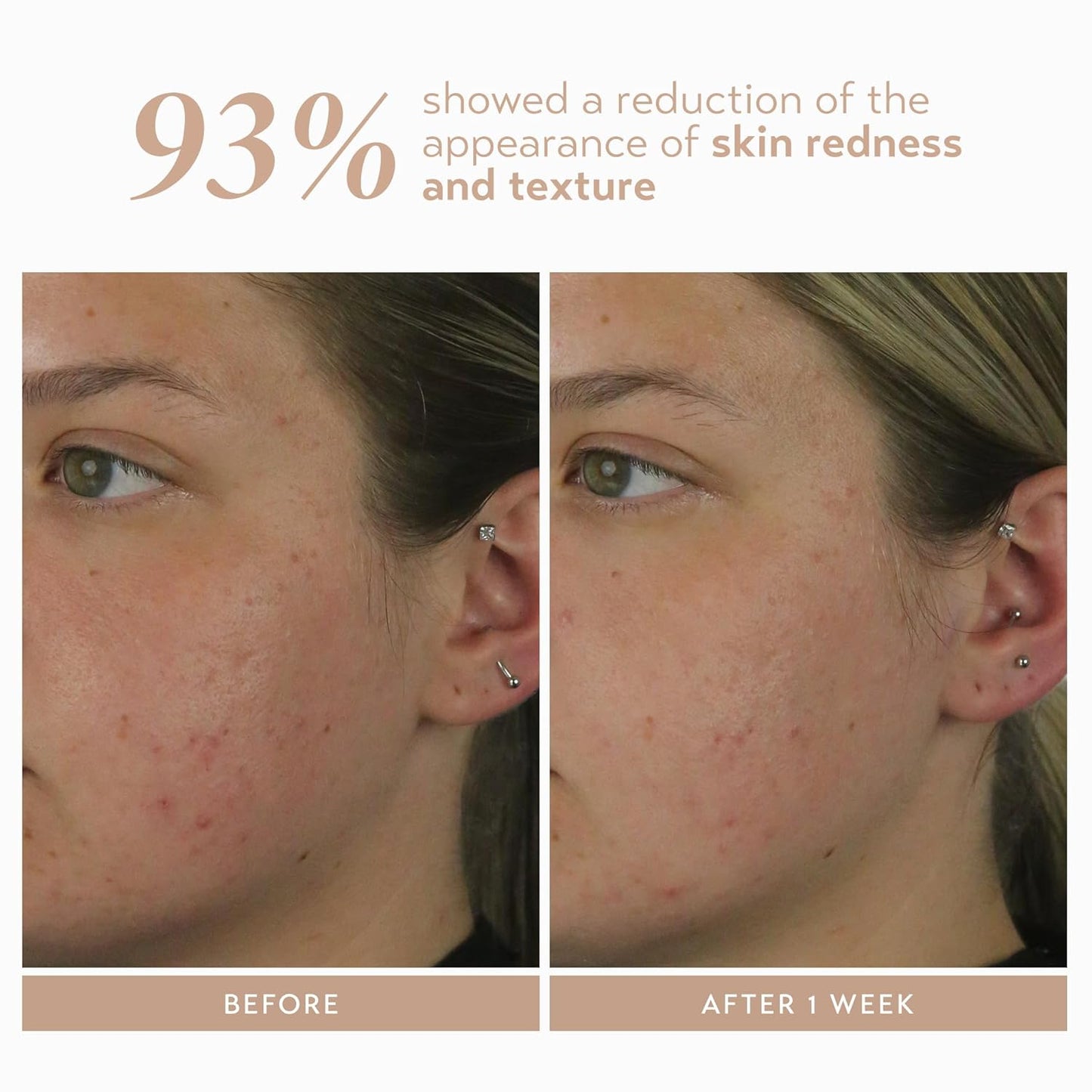 Shani Darden Rescue Serum - 10% Azelaic Acid for Redness & Acne Relief | Lightweight Hydrating Formula, 1 fl oz