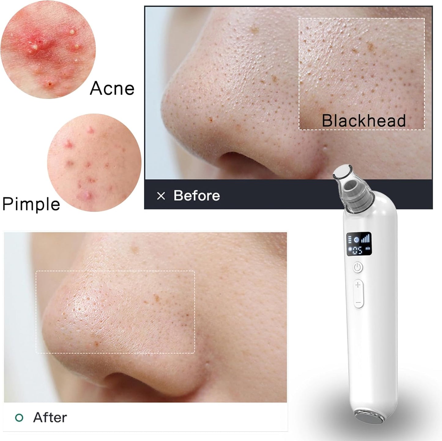 Blackhead Remover Vacuum - Rechargeable Pore Cleaner with Heat & Red Light | 5 Suction Levels, LED Display, 6 Probes & Bonus Extractor Tools