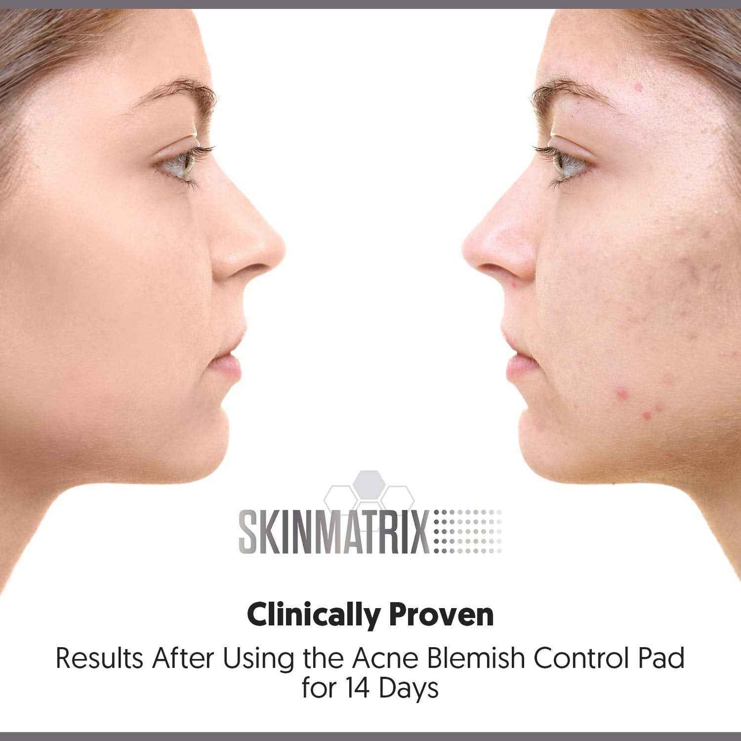 YISHIQIAnti-Blemish Acne Control Pads- Contains Salicylic, Lactic, & Mandelic Acid. Clears Away Clogged Pores, Whitehead & Blackhead Pimples. Eliminates Acne for Face & Body.