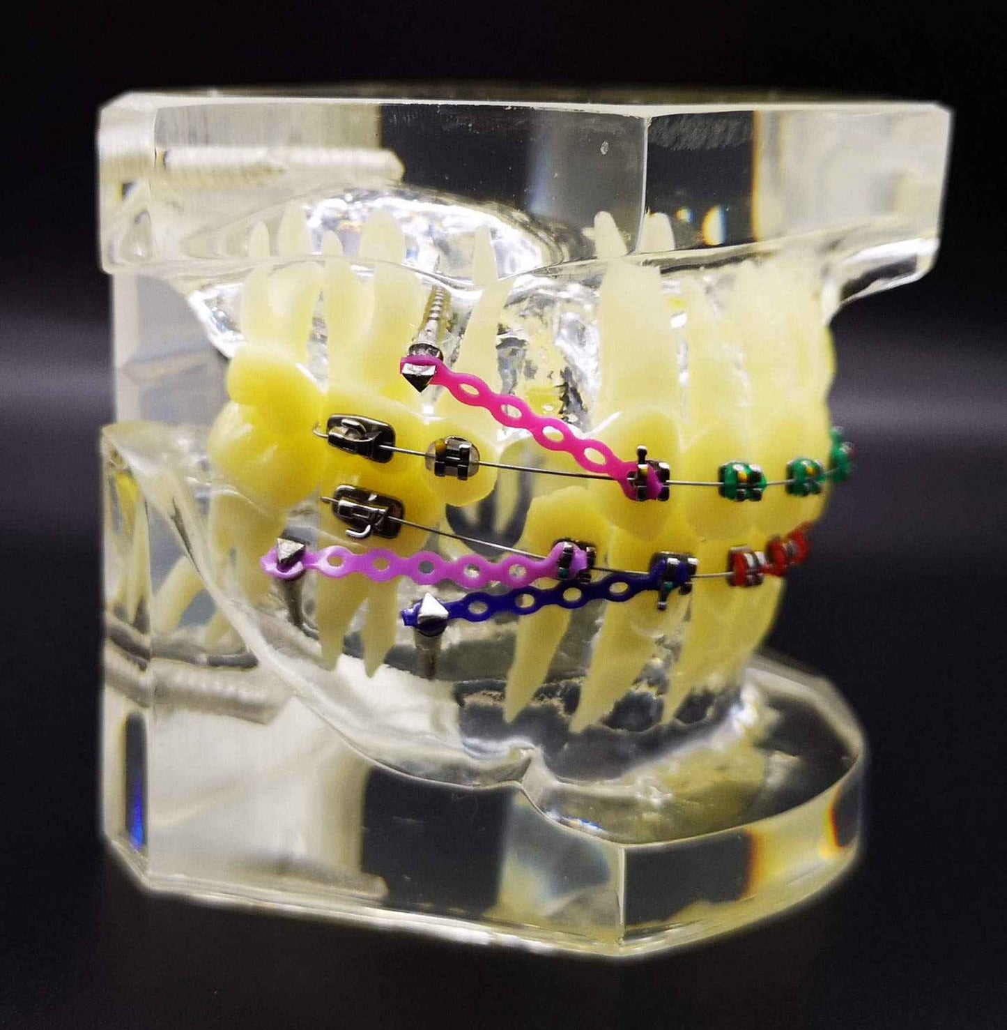 Dental Typodont with Metal Brackets Orthodontic Teeth Model with Ligature Tie