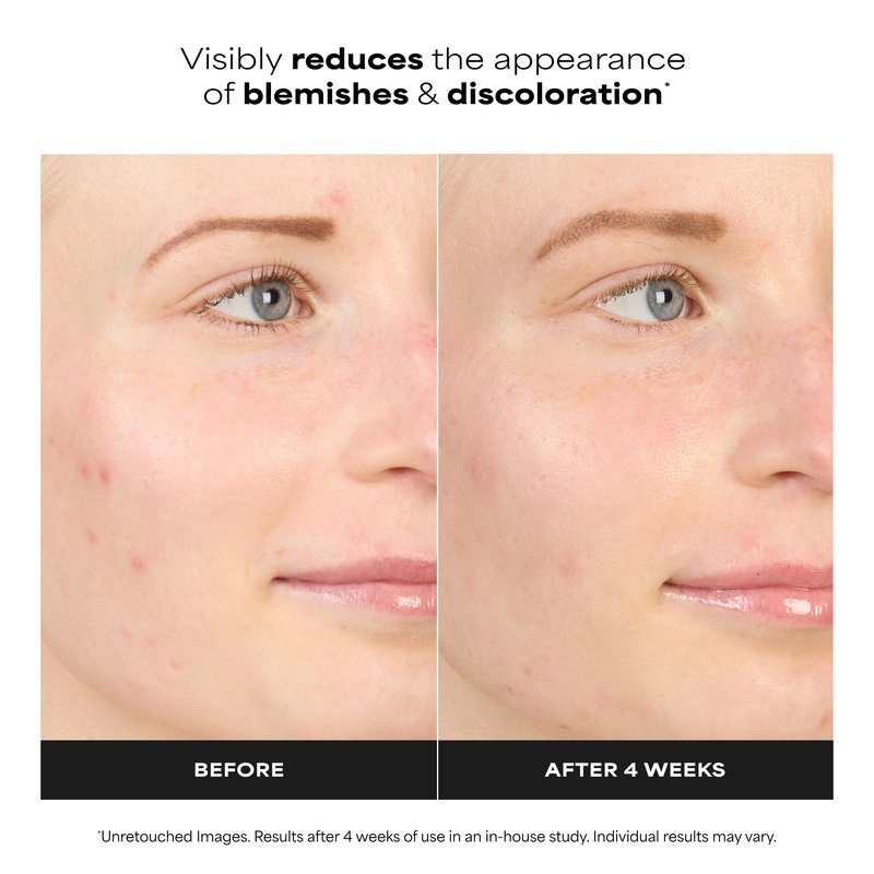 Paula’s Choice BOOST 10% Azelaic Acid Booster Cream Gel, Oil-Free Serum Fades Discoloration & Post-Blemish Marks, with Licorice Extract & Salicylic Acid, Fragrance-Free, 0.17 Fl Oz
