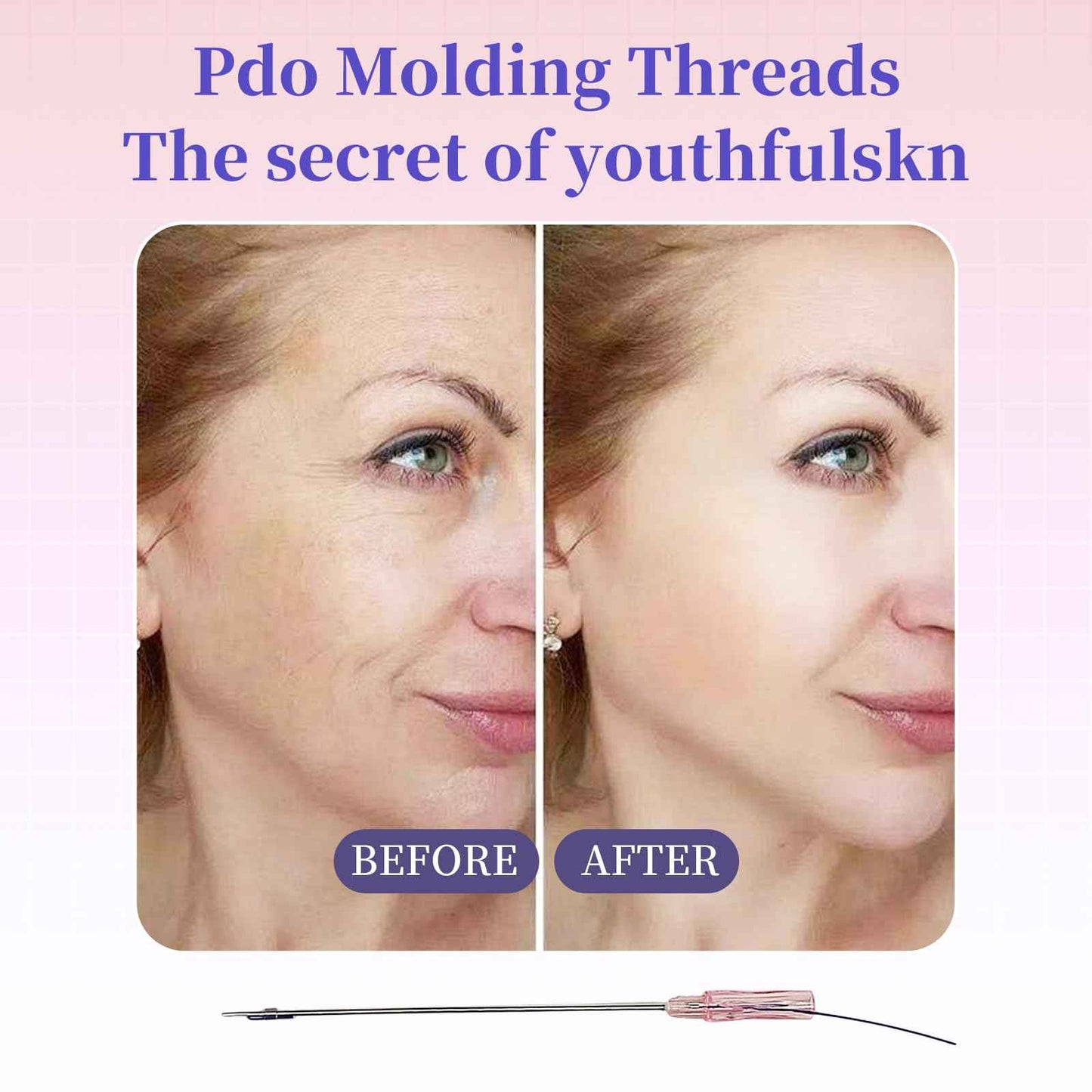 Pdo threads for face lift PDO Screw Threads 20PCS – Twisted Design for Cheeks & Jawline(s27g50mm)