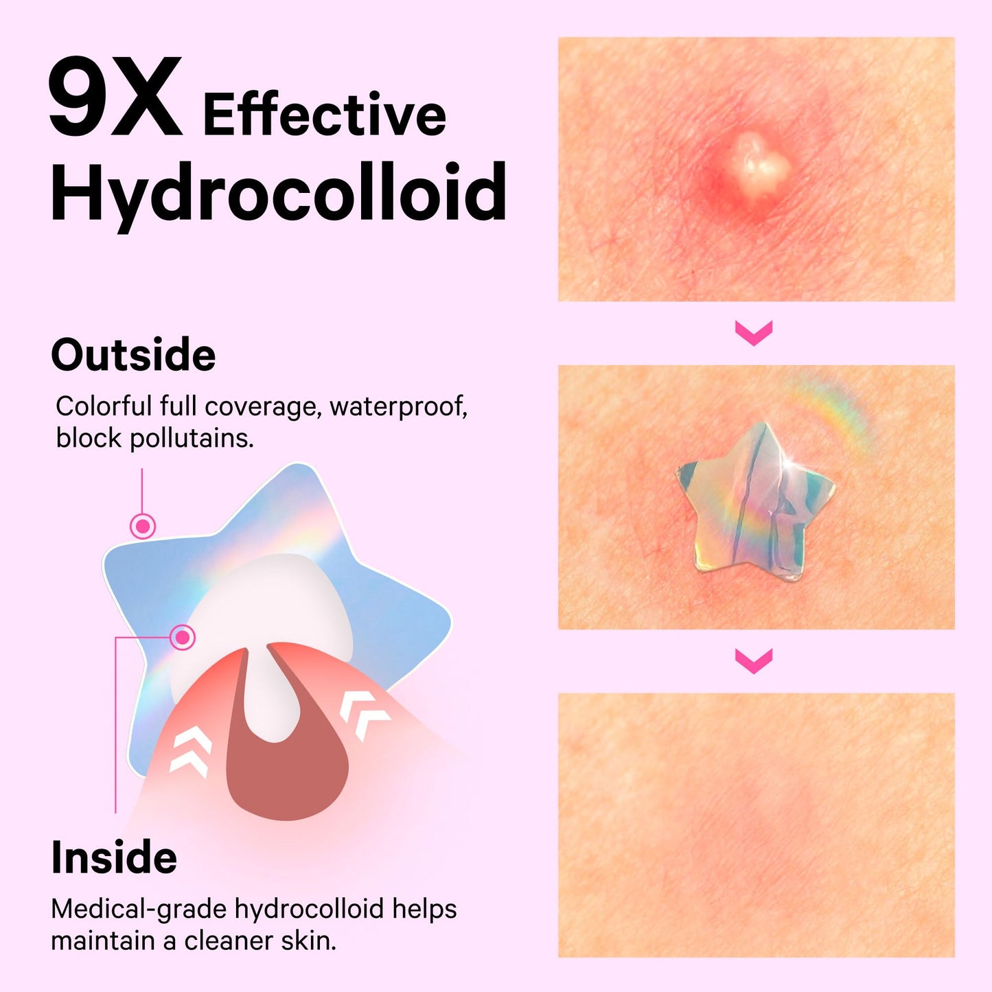 Sosky Hologram Pimple Patches for Face, Hydrocolloid Acne Patches with Salicylic Acid, Cute Star Zit Stickers,Colorful Blemish Covers,144 Count Pink Star Heart Moon Cloud Butterfly Flower