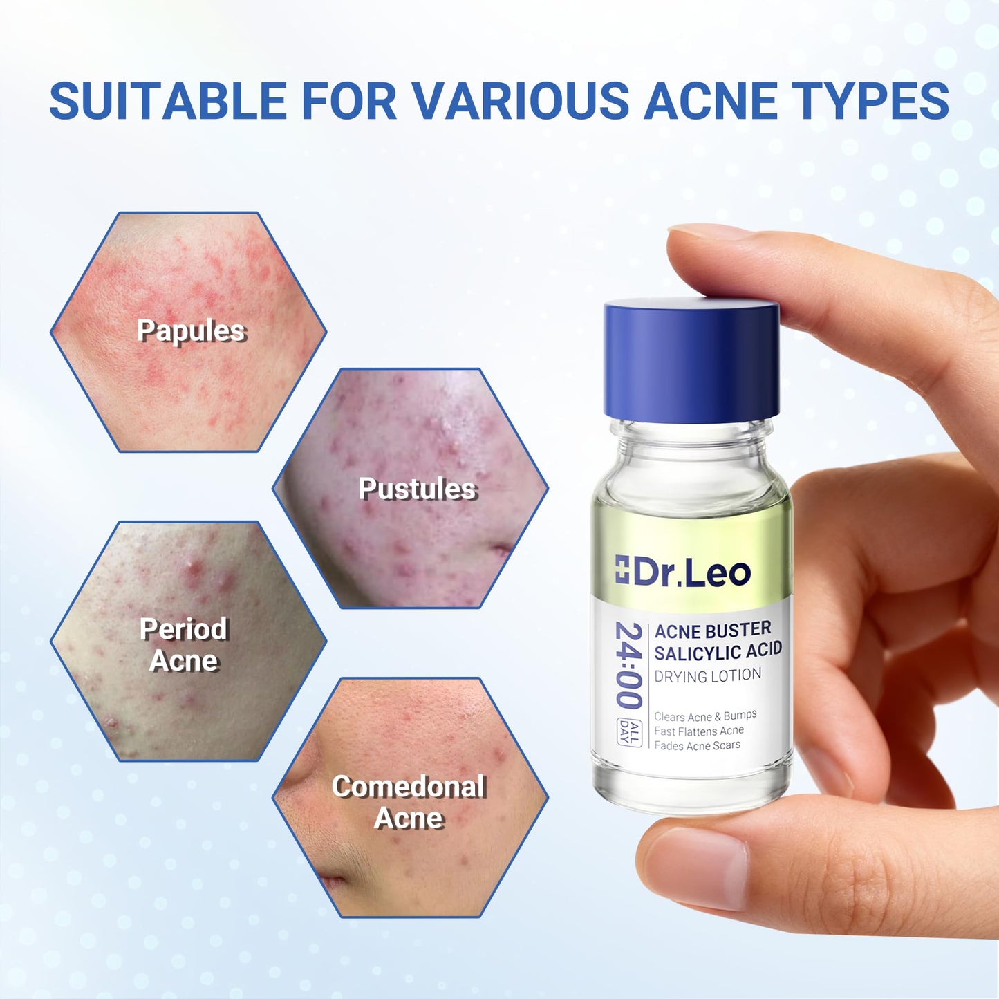 Salicylic Acid Acne Treatment Drying Lotion