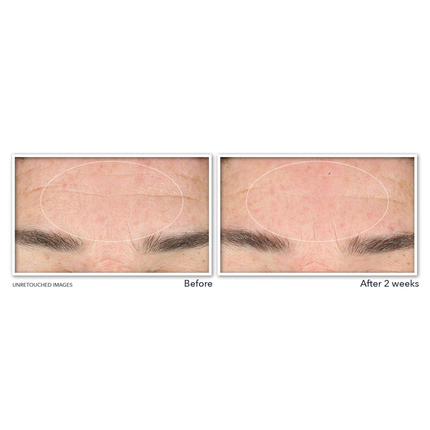 RoC Retinol Correxion Deep Wrinkle Serum - Anti-Aging Facial Cleanser with Niacinamide, 6 oz