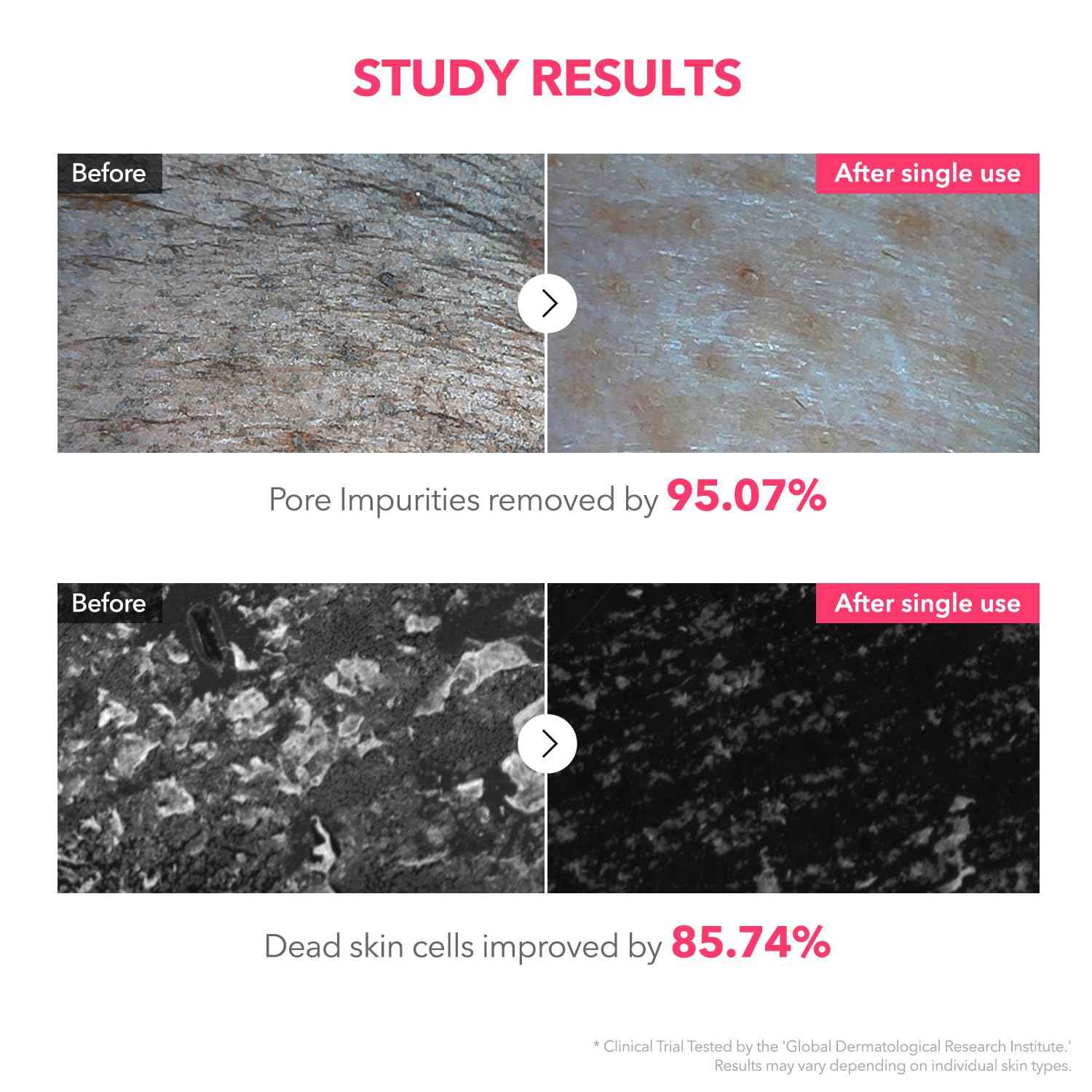 APRILSKIN TXA Bubble Gum Cleanser with Pore Brush: TXA Niacinamide 99 Pore Care Pink Bubble Gum Deep Cleanser(4.23 fl.oz.)+Pore Cleansing Facial Silicone Brush