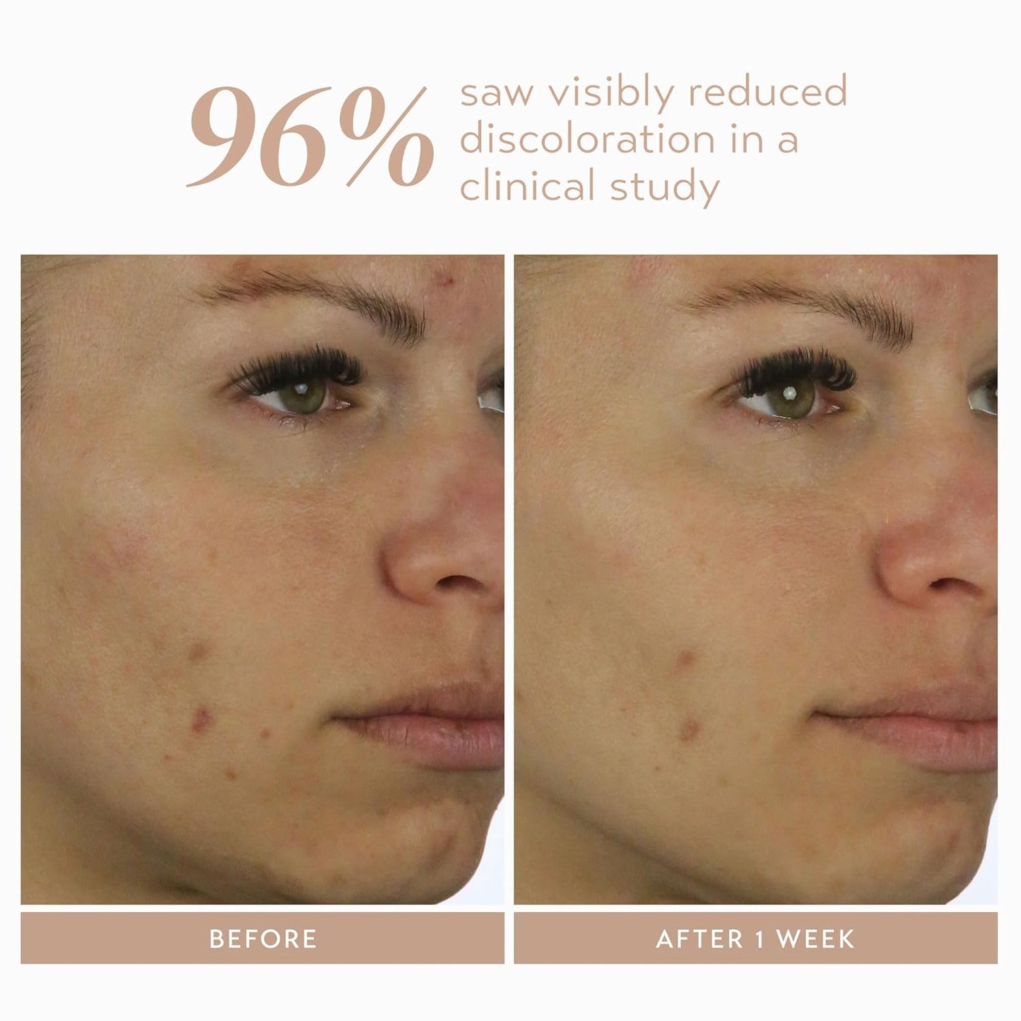 Shani Darden Rescue Serum - 10% Azelaic Acid for Redness & Acne Relief | Lightweight Hydrating Formula, 1 fl oz