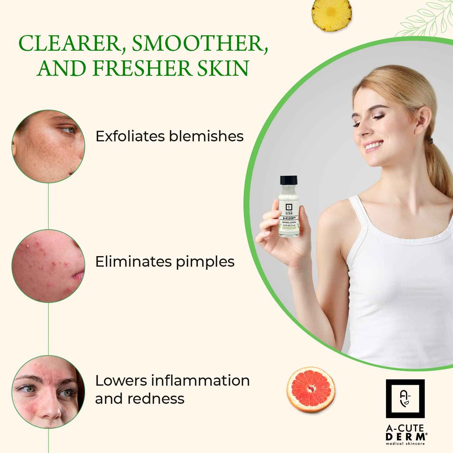 A-Cute Derm B-Kleer Drying Lotion Advanced Blemish Spot Treatment for Pimples, Razor Bumps & Oily T-Zone Fast-Acting Overnight Formula, Use Day or Night 0.5 oz
