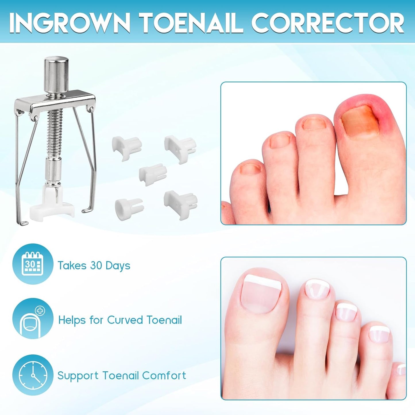 Ingrown Toenail Removal Kit - Professional Tool Set with Corrector Drops, Clipper & Nail File | Complete Pedicure Solution