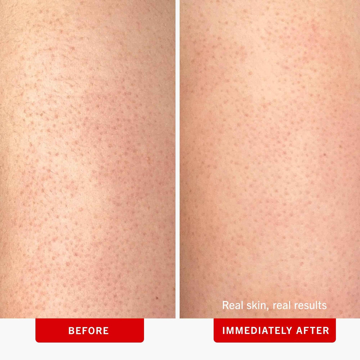 First Aid Beauty - KP Bump Eraser Body Scrub with 10% AHA, Keratosis Pilaris Skin Exfoliater with Glycolic and Lactic acids, Helps Reduce Chicken Skin Bumps, Safe for Sensitive Skin, 4 oz