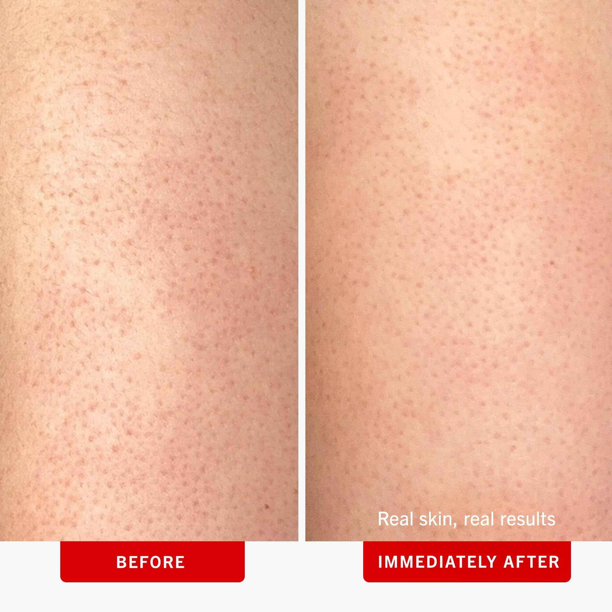 First Aid Beauty - KP Bump Eraser Body Scrub with 10% AHA, Keratosis Pilaris Skin Exfoliater with Glycolic and Lactic acids, Helps Reduce Chicken Skin Bumps, Safe for Sensitive Skin, 4 oz