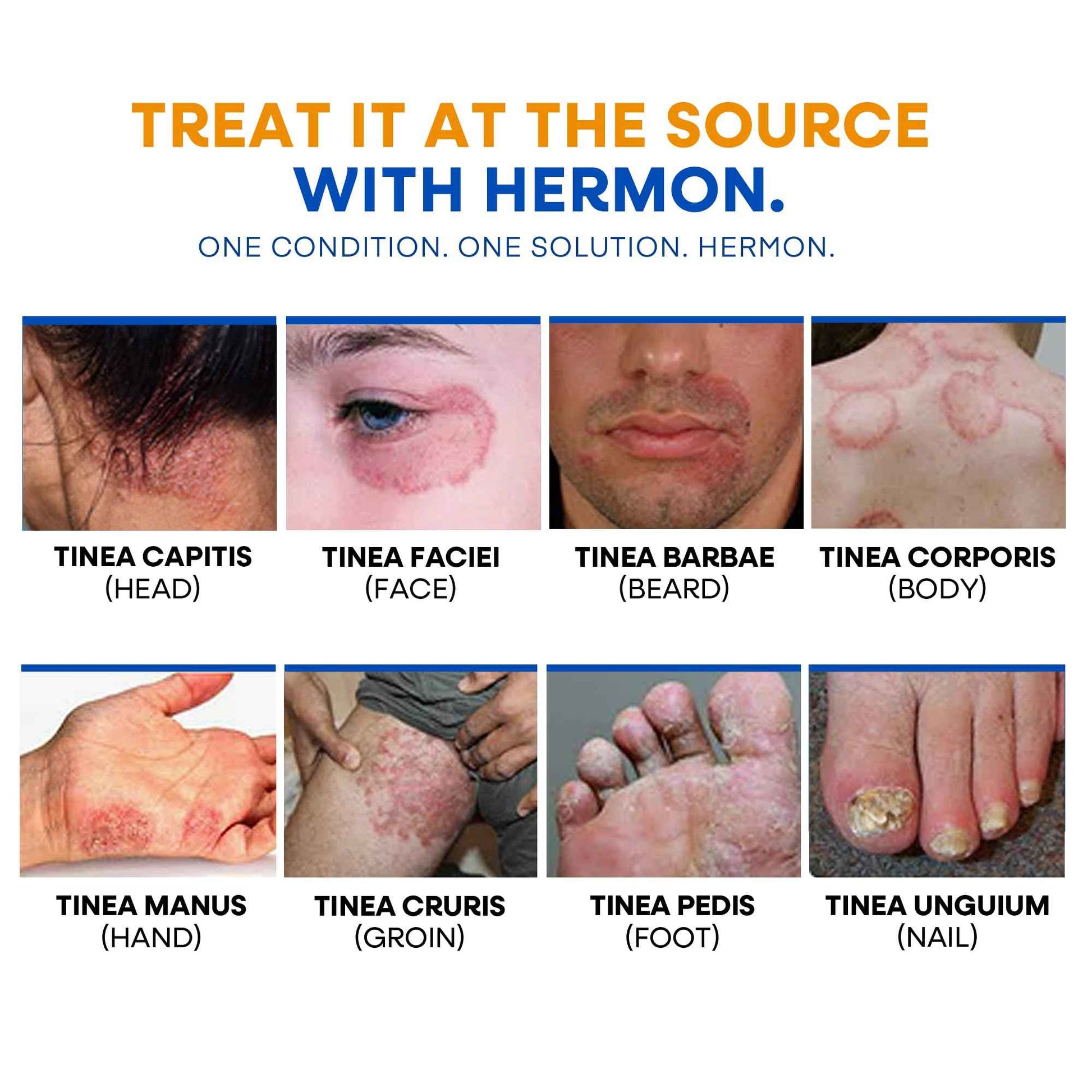 Hermon Powerful Ringworm Antifungal Soap – Treatment for Ringworm, Athlete’s Foot & Jock Itch – Tea Tree Oil & Sulfur Formula – Fungal Soap for Daily Body Wash – 2 Pack