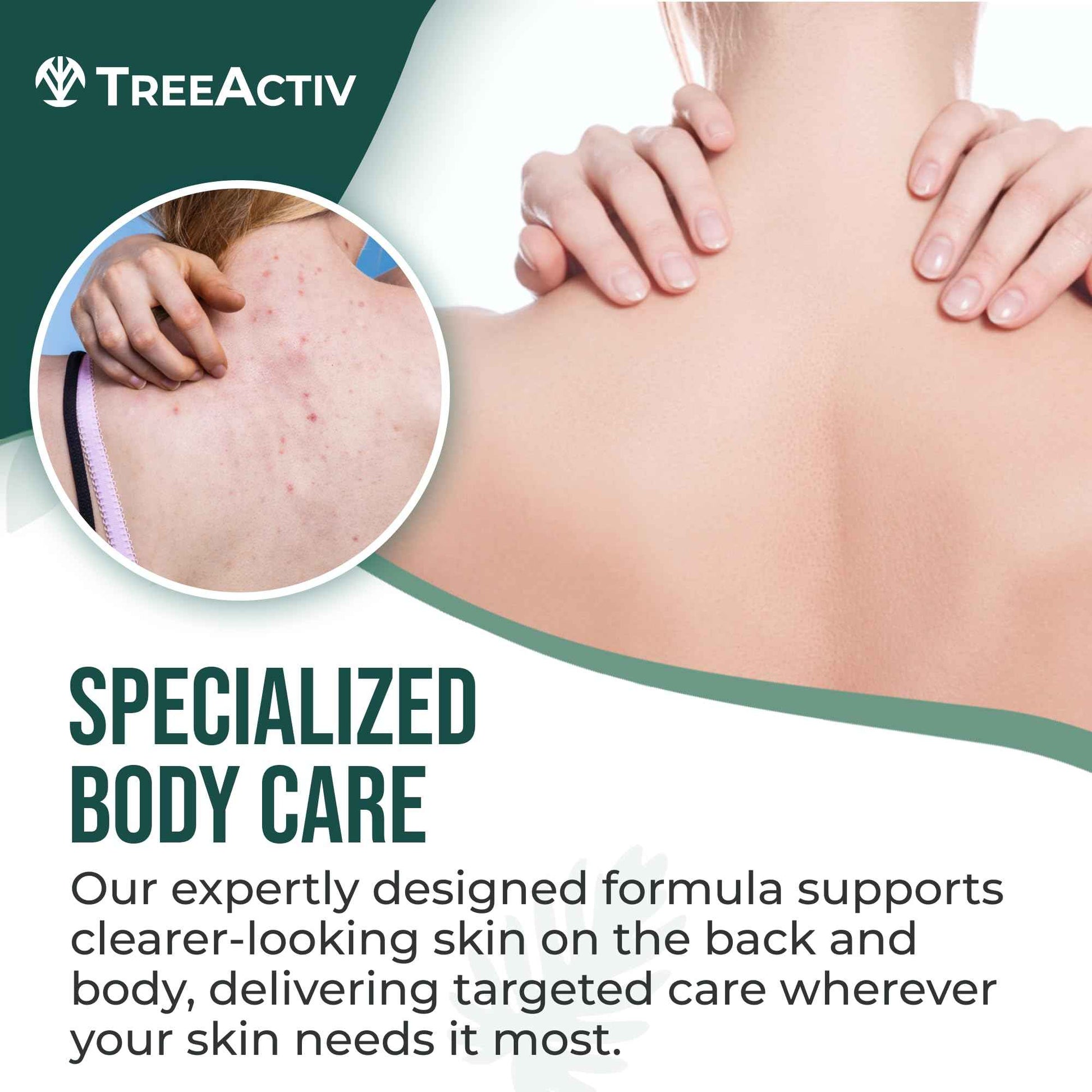 TreeActiv Body & Back Acne Treatment Original Formula, 8 fl oz, 2% Salicylic Acid, Cystic & Body Acne Spray for Chest, Shoulders & More, Bacne Treatment for Teens & Adults