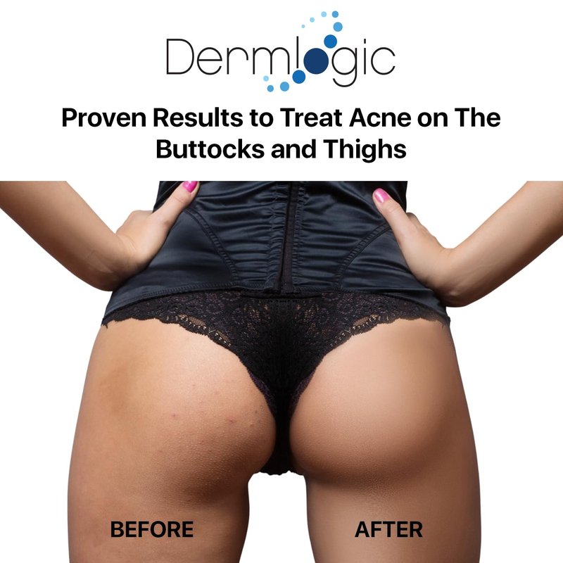Butt & Thigh Acne Treatment - Fights Acne, Pimples, Zits, Blackheads and Ingrown Hairs for the Buttocks and Thigh Area. Fades Away Dark Spots, Acne marks. Prevents Future Breakouts. 6.09 oz