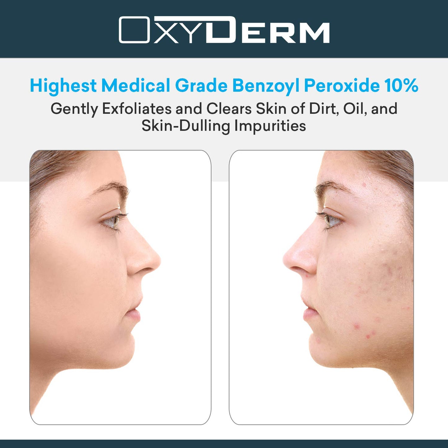 Acne Face wash Treatment with Benzoyl Peroxide 10% - Clears Cystic Breakouts & Fights Acne Blemishes on Contact. Prevents Future Pimples, Blackheads, Whiteheads, Zits, Bumps. For Face & Body.