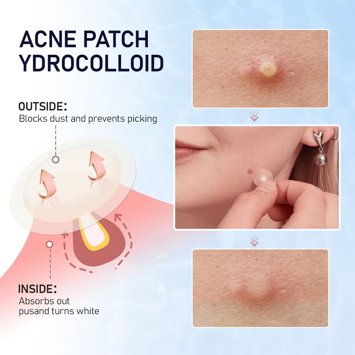 ANGTICS Pimple Patches for Face, 2 Sizes 192 Counts Acne Patches, Hydrocolloid Patches Zit Patches for Skin Care, Blemish Patches Invisible Acne Spot Treatment with Salicylic Acid, Tea Tree Oil