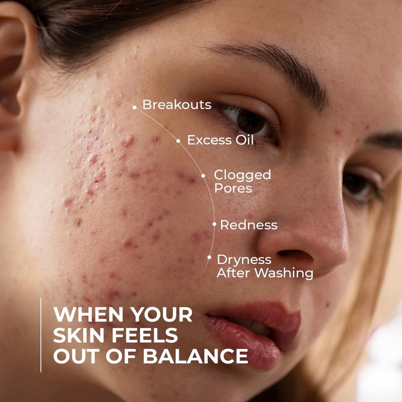 Clarifying Acne Control Face Cleanser - Salicylic Acid & Niacinamide for Oily Skin | Unclogs Pores, Fights Breakouts