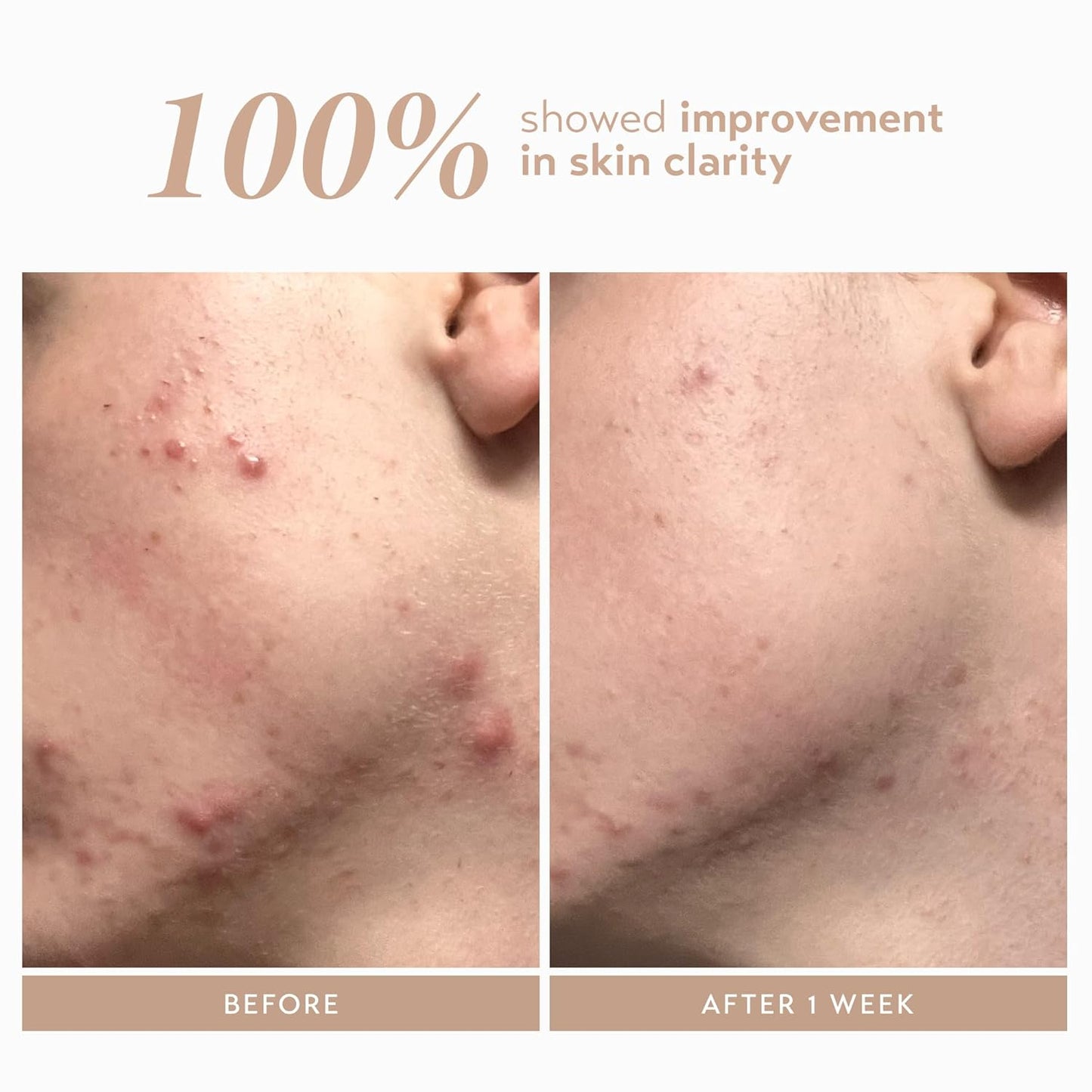 Shani Darden Rescue Serum - 10% Azelaic Acid for Redness & Acne Relief | Lightweight Hydrating Formula, 1 fl oz