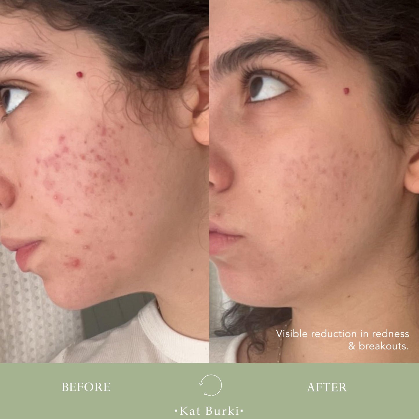 KAT BURKI VitaBiome Active Skin Optimizer With Vitamin C. Advanced Clearing and Redness Relief Face Mist for Breakout-Prone Skin, 1 Fl Oz