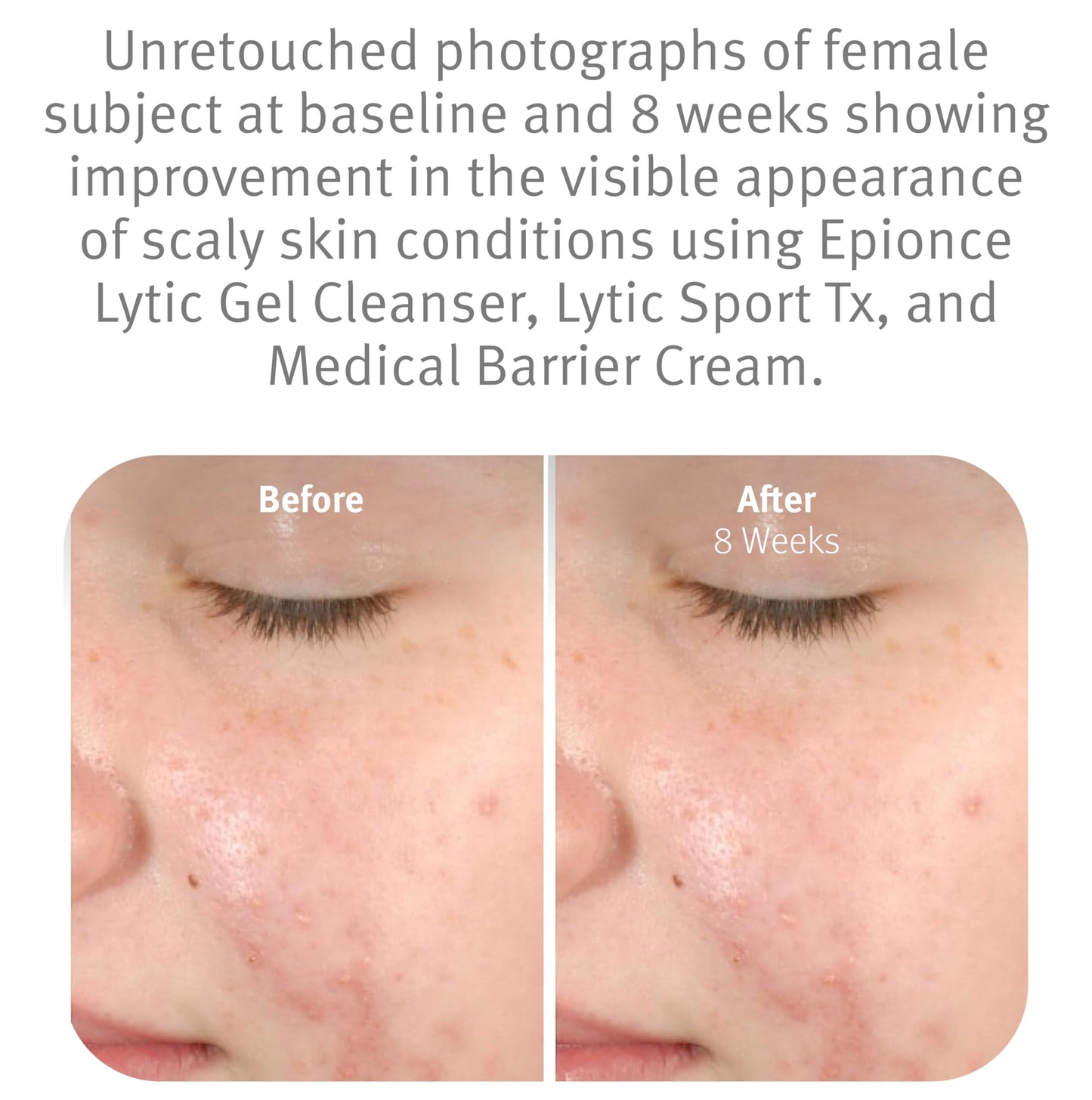 Epionce Lytic Gel Cleanser Gentle Foaming Face Wash Blemish Makeup Remover