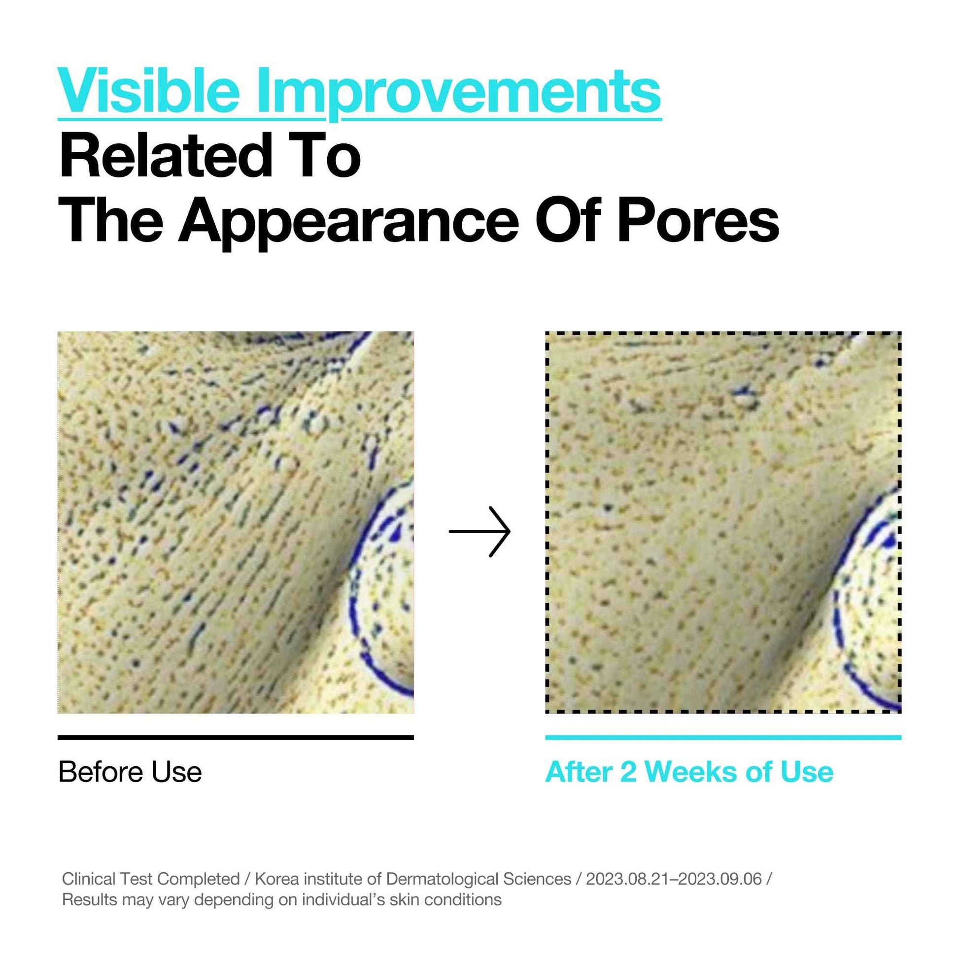 ANUA BHA 2% Gentle Exfoliating Toner, Mild Facial Exfoliant, Salicylic Acid for Pores and Sebum, Teatree Extract, Hyaluronic Acid, Ceramides (150ml / 5.07 fl.oz.)