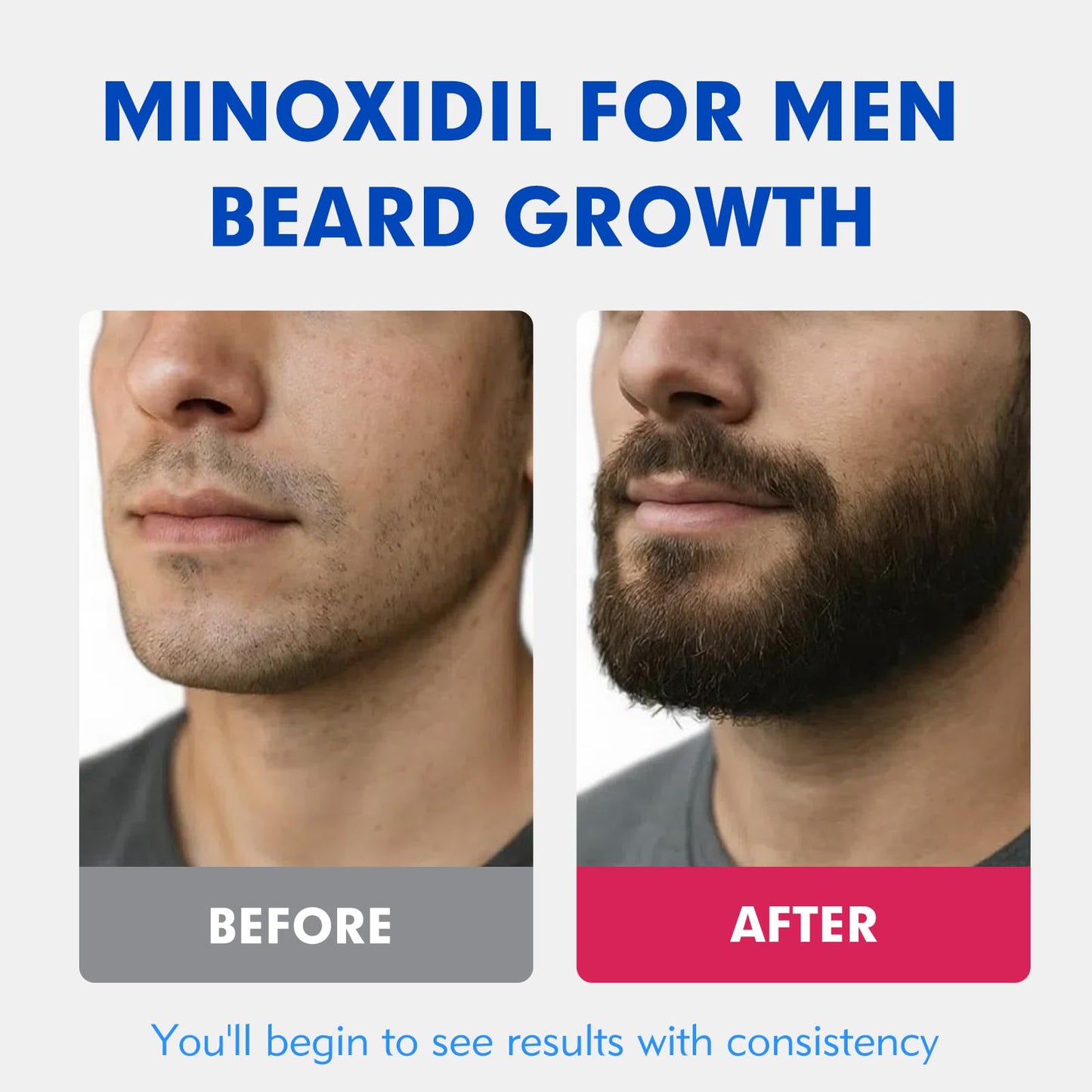 5% Minoxidil for Men Hair Regrowth Treatment, Extra Strength Topical Solution for Thinning Hair & Balding, Beard Growth Enhancer, Non-Greasy Fast-Absorbing Formula, 4-Pack (240ml) 4-Month Supply