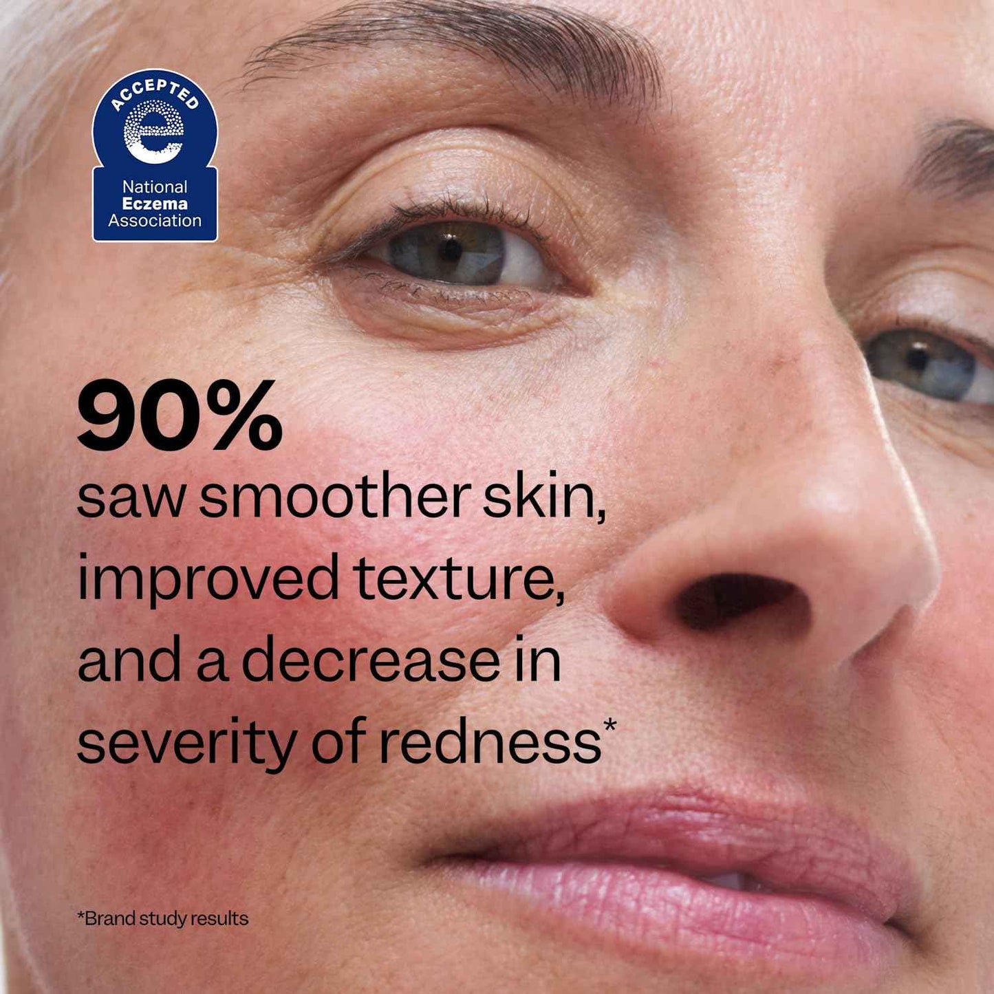 Peach Slices - Redness Relief 10% Azaleic Acid Serum (1.01 oz) - Advanced Skincare - Includes Panthenol, Cica, Algae - Vegan, Cruelty-Free, Korean Skincare & Beauty