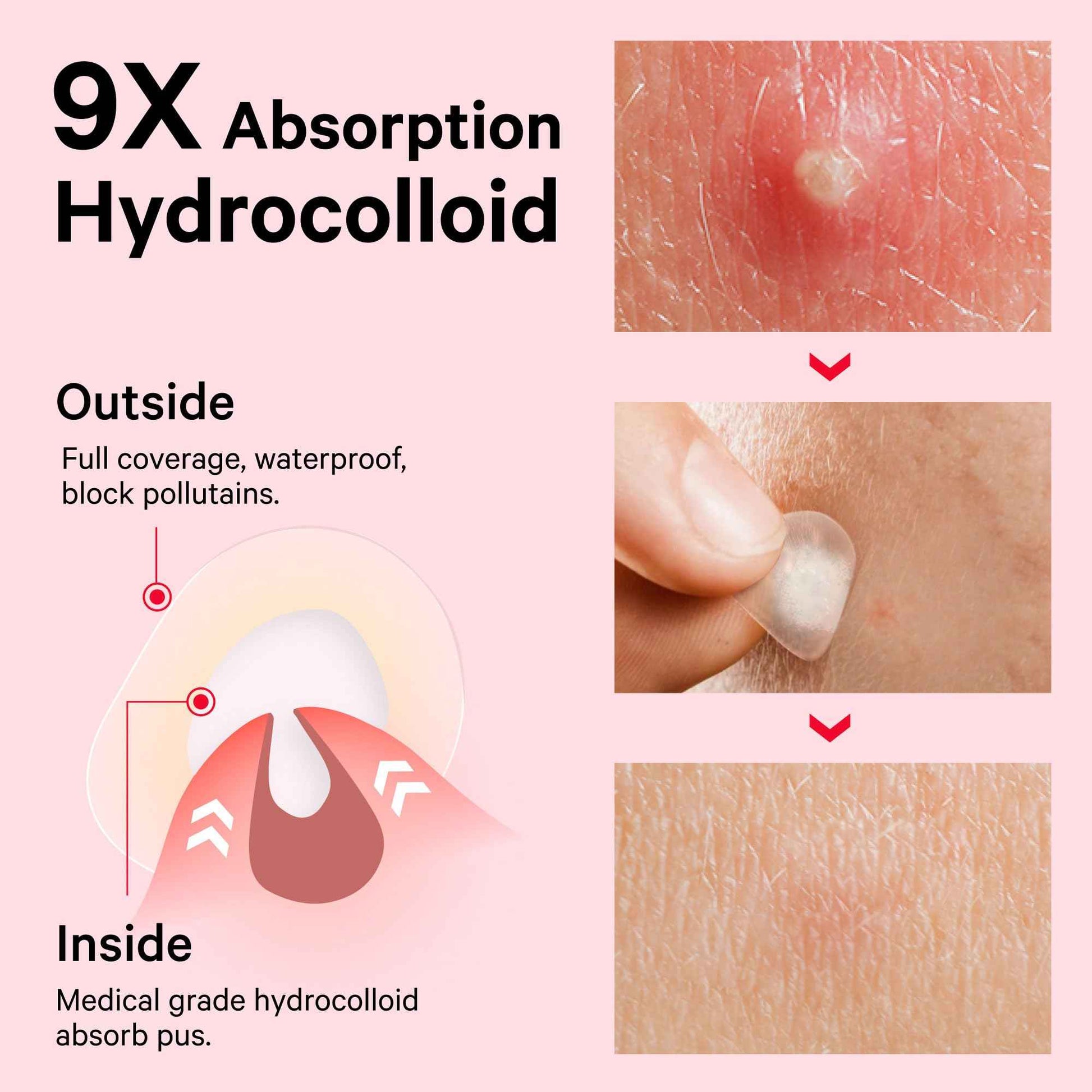 Sosky Pimple Patches for Face, FSA HSA Eligible Invisible Hydrocolloid Acne Patches, Pimple Patches for Covering Zits, Blemishes with Salicylic Acid 2 Sizes 48 Count and 96 Count