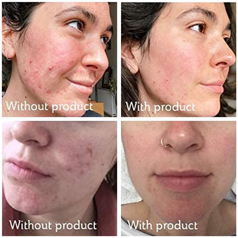 Science of Skin Rescue No. One - Blemish & Acne Scar Treatment Cream | Fast-Acting Formula