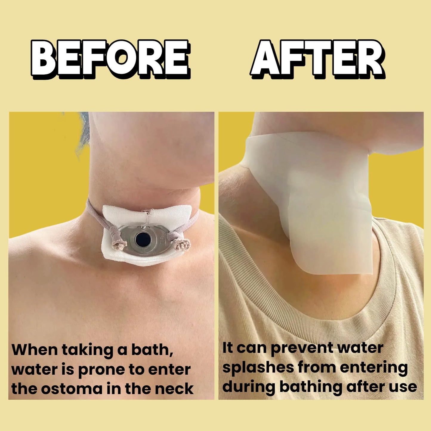 Sulieschen Stoma Guard Tracheostomy Shower Cover – Waterproof Silicone Neck Protection for Post-Tracheotomy Patients, Adjustable Fit, Breathable, Safe & Comfortable, Practical Gift for Recovery