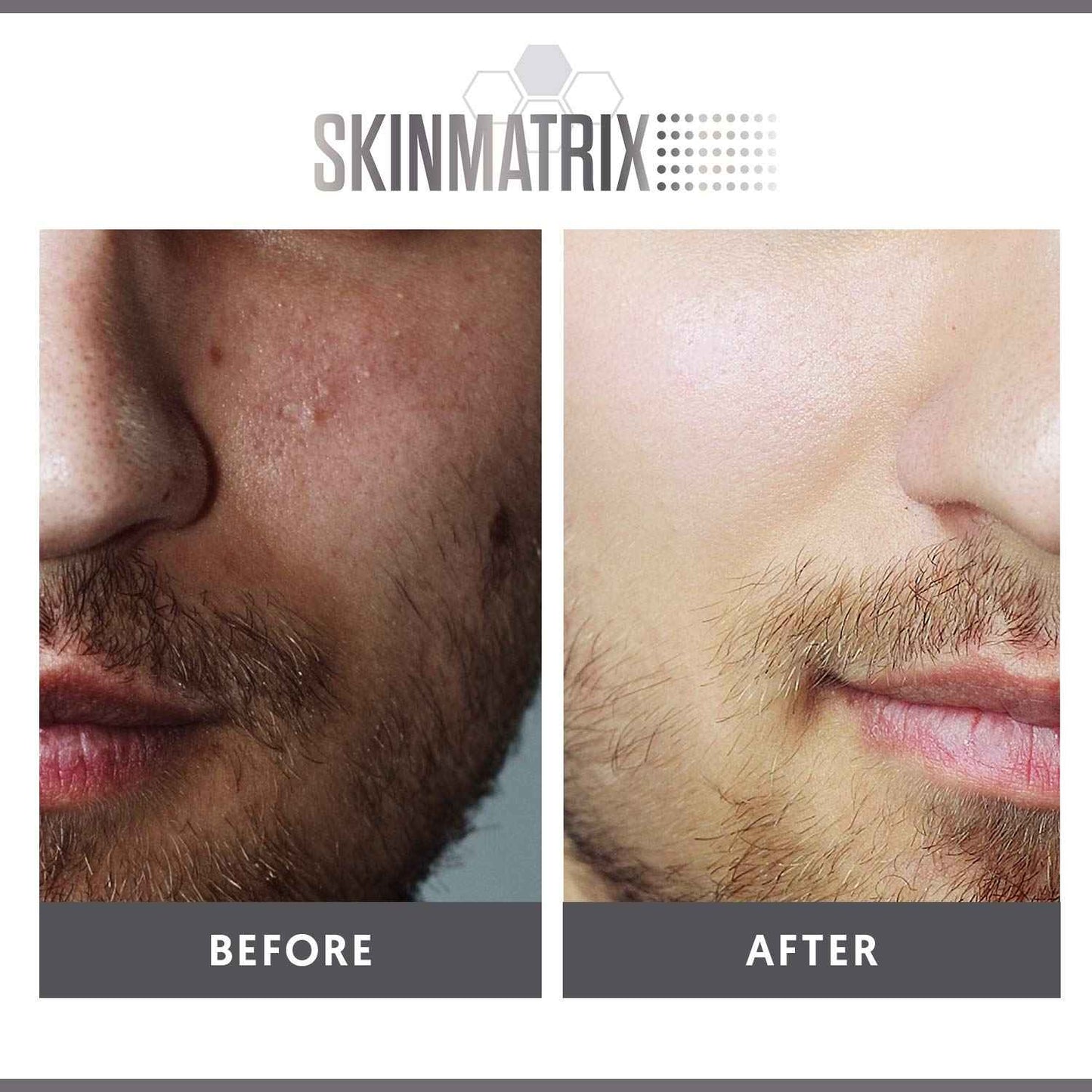 YISHIQIAnti-Blemish Acne Control Pads- Contains Salicylic, Lactic, & Mandelic Acid. Clears Away Clogged Pores, Whitehead & Blackhead Pimples. Eliminates Acne for Face & Body.