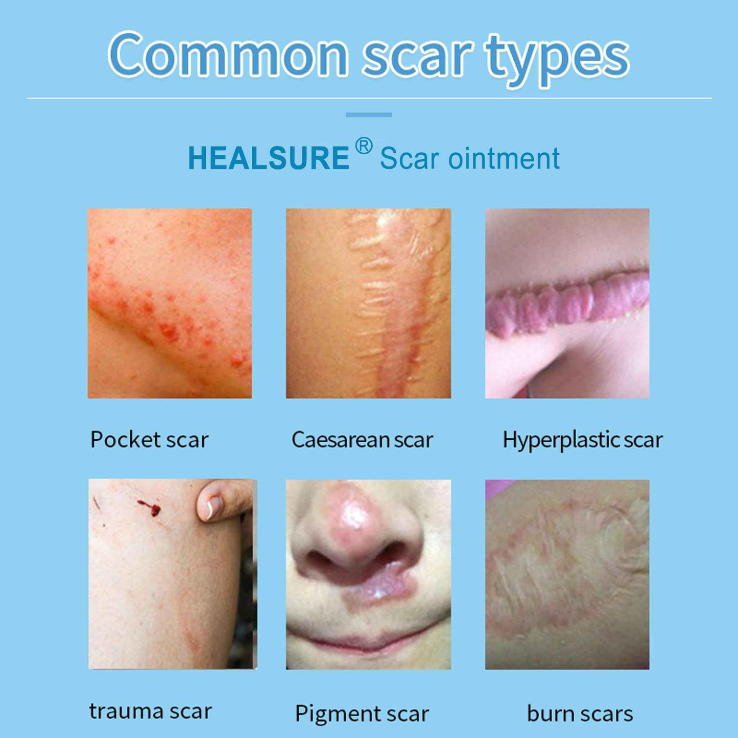 Silicone Scar Gel, Scar Cream for Acne Scars, C-Section, Hypertrophic & Dark Scars, Fade Scars & Improve Skin