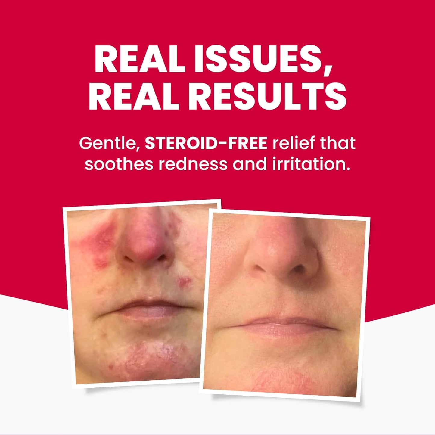 Natural Rosacea Treatment - Anti-Redness Face Cream to Soothe Flare-Ups | Hypoallergenic, Steroid-Free (2.64 fl oz)
