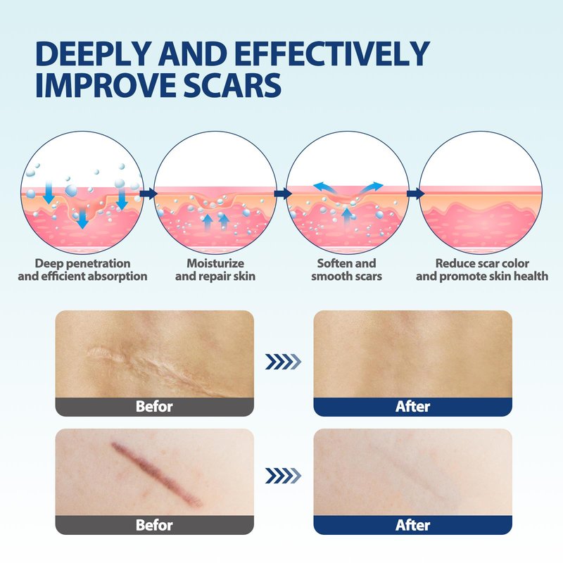 Boysea Scar Cream & Serum Oil, Advanced Scar Removal Set, Reduces Appearance of Keloids, C-Sections, Surgeries, Burns, Acne, 2 x 1.06 Oz Bottles