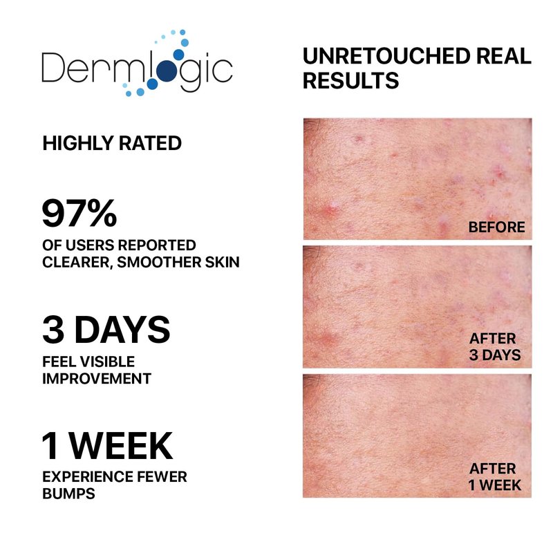 Butt & Thigh Acne Treatment - Fights Acne, Pimples, Zits, Blackheads and Ingrown Hairs for the Buttocks and Thigh Area. Fades Away Dark Spots, Acne marks. Prevents Future Breakouts. 6.09 oz