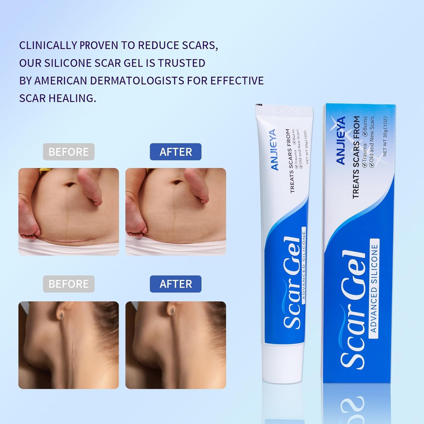Silicone Scar Gel - Advanced Scar Cream for Old & New Scars | Fades C-Section, Keloids, Stretch Marks, Burns