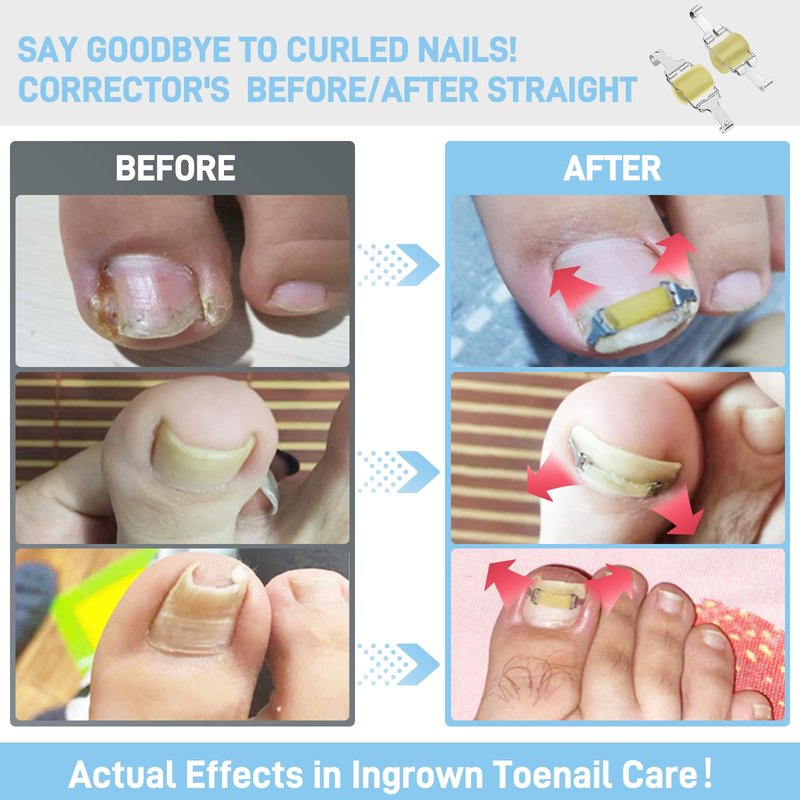 InhwRior Ingrown Toenail Corrector, Easy At-Home Application, Secure Fit (No Slipping Off), Steady Traction for Rapid Pain Relief, Waterproof for Shower & Swimming(0.83" to 0.91" Toenail Length)
