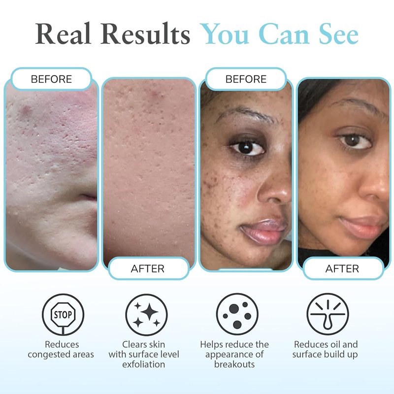 Salicylic 30% Gel Peel - Exfoliating Treatment with Tea Tree Oil & Green Tea Extract | 1 oz