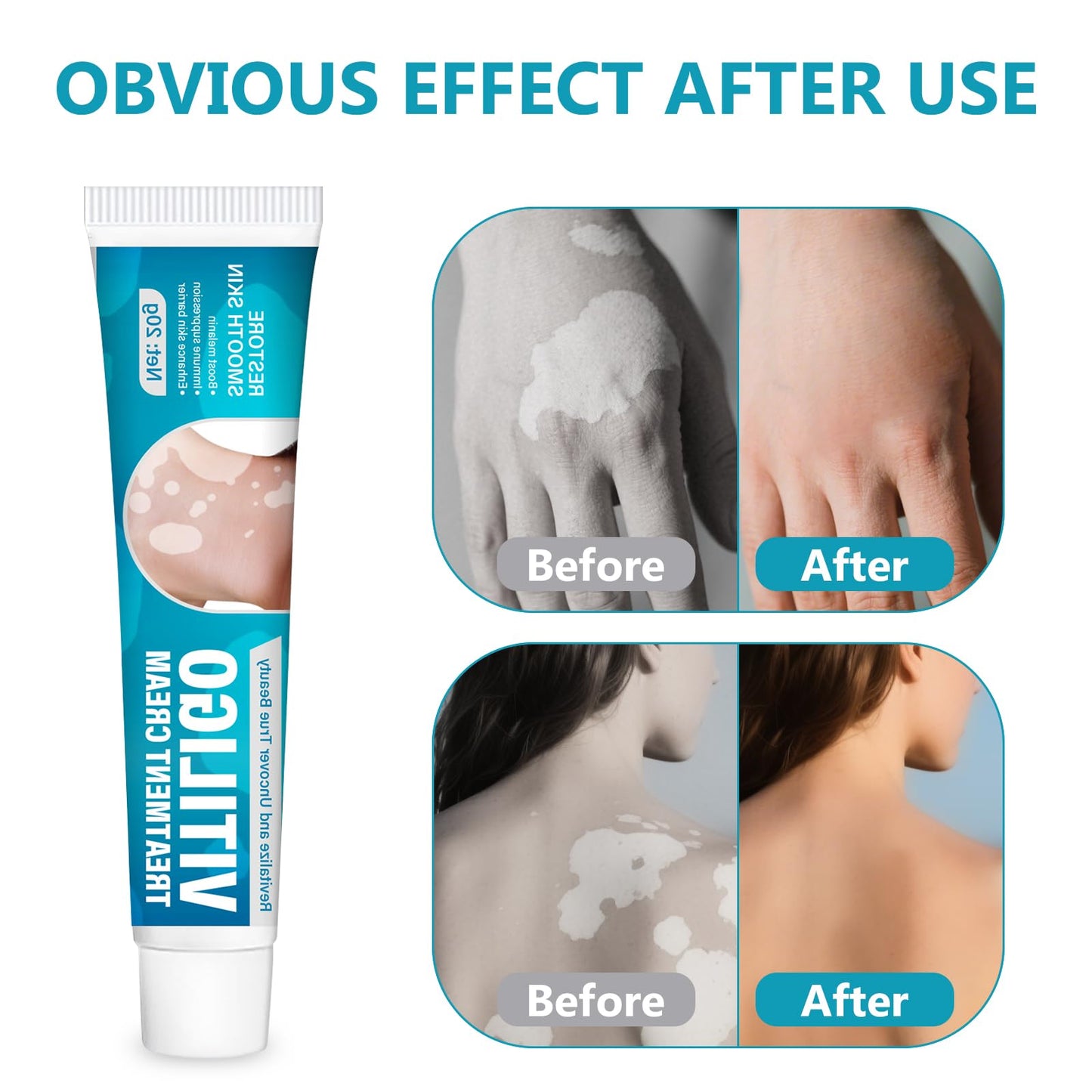 Vitiligo Cream| Effective Treatment of Skin Vitiligo, Reduce Uneven Skin Tone, White Spots, Promote Melanin Production of the Active Ingredients, Suitable for Both Men and Women, 20G