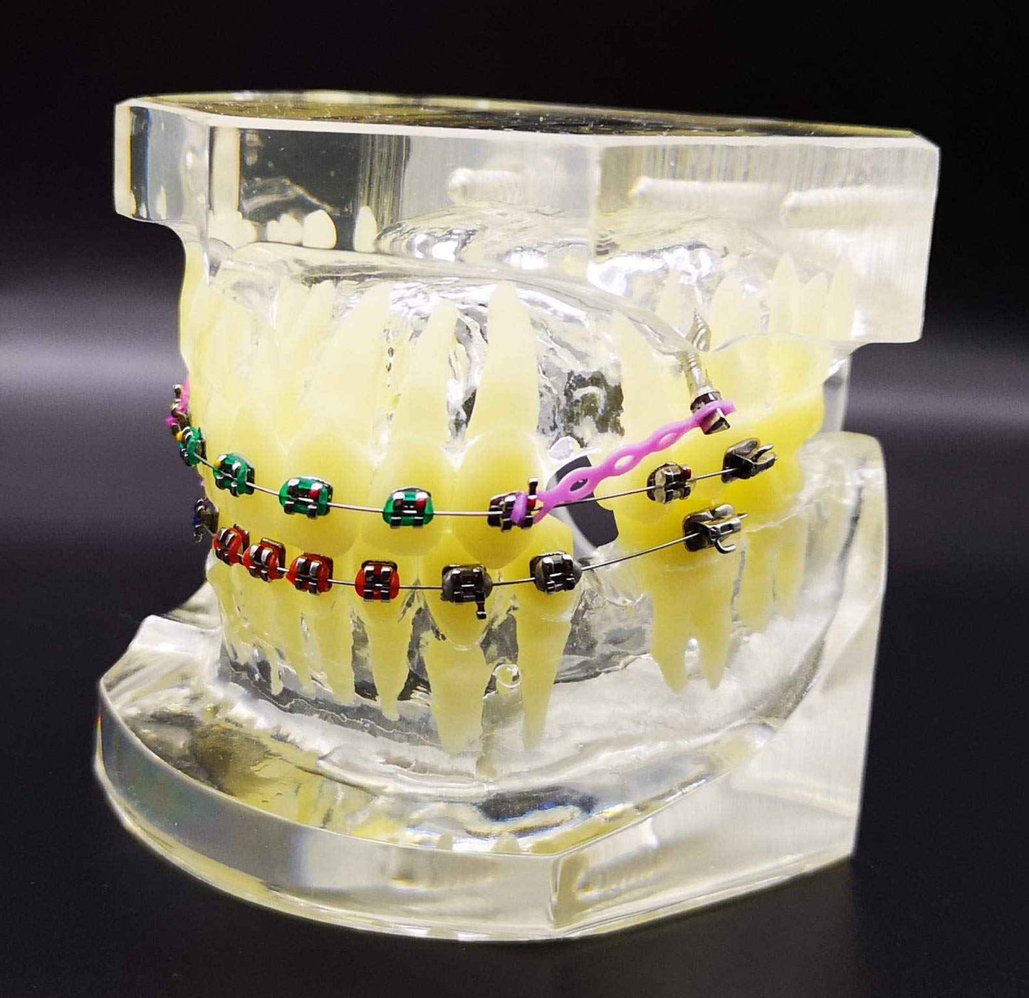 Dental Typodont with Metal Brackets Orthodontic Teeth Model with Ligature Tie