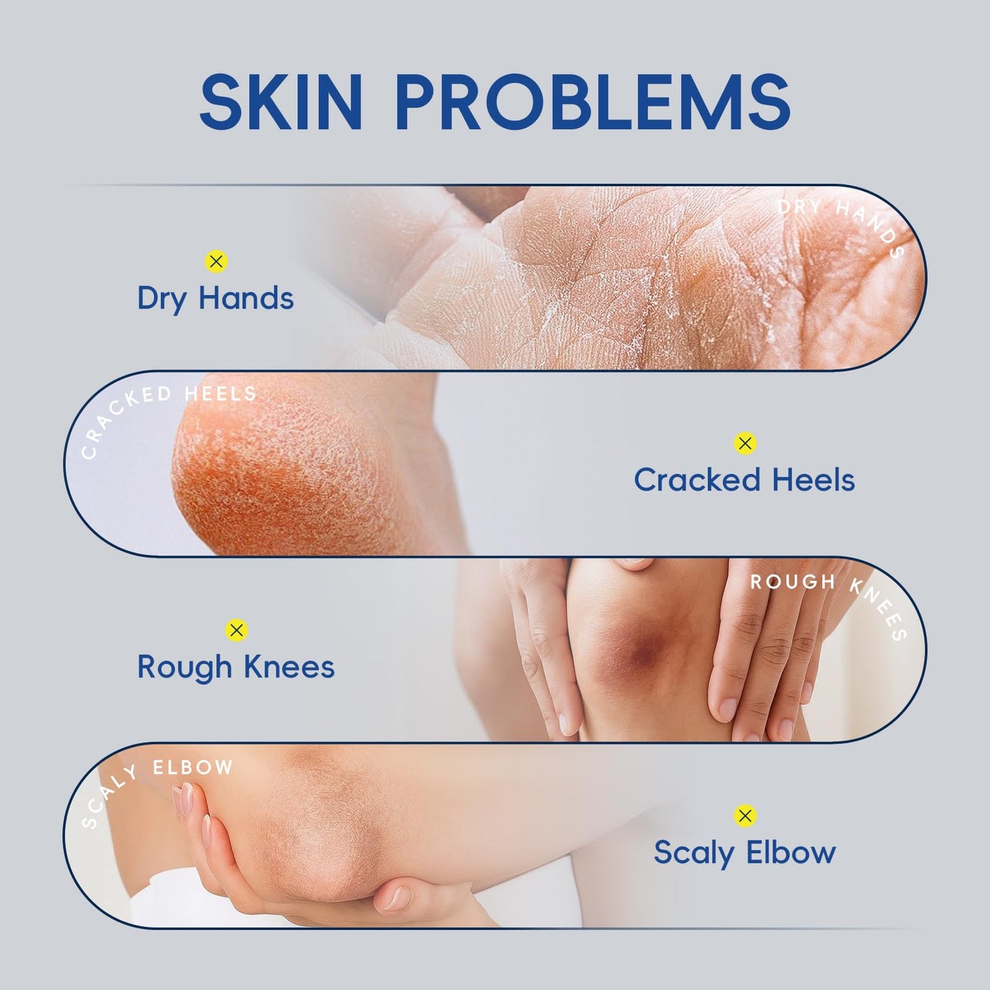 2 Pack Urea Cream 40% + 2% Salicylic Acid, 3.53 oz - Maximum Strength Foot & Hands Moisturizer for Rough, Dry Cracked Skin, Callus Remover with Deep Hydration, Intensive Repair for Feet, Heels