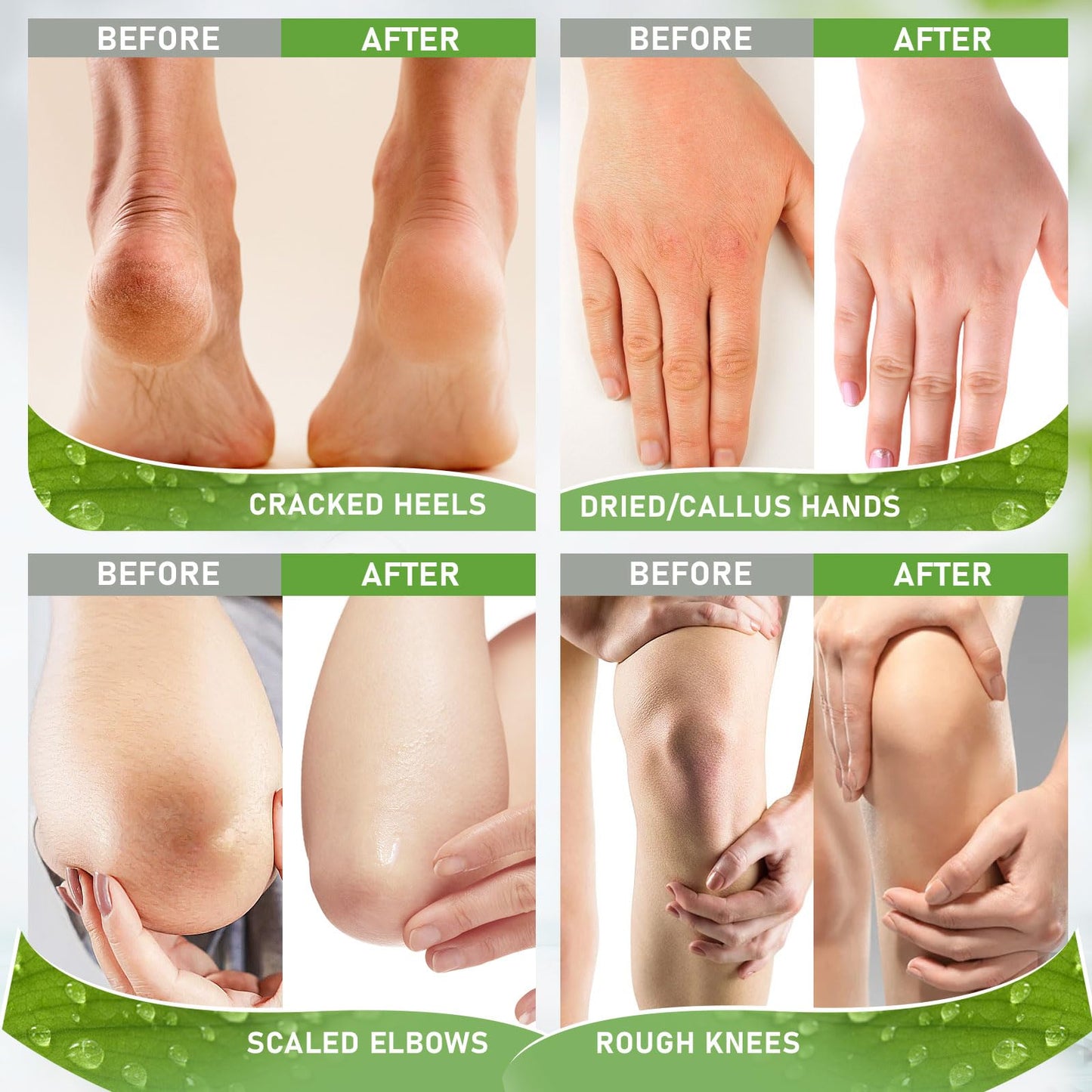 Ultrove Urea Cream 42% - 2% Salicylic Acid Foot Moisturizer - Callus & Dead Skin Remover, Repairing Foot File, 3.5 oz