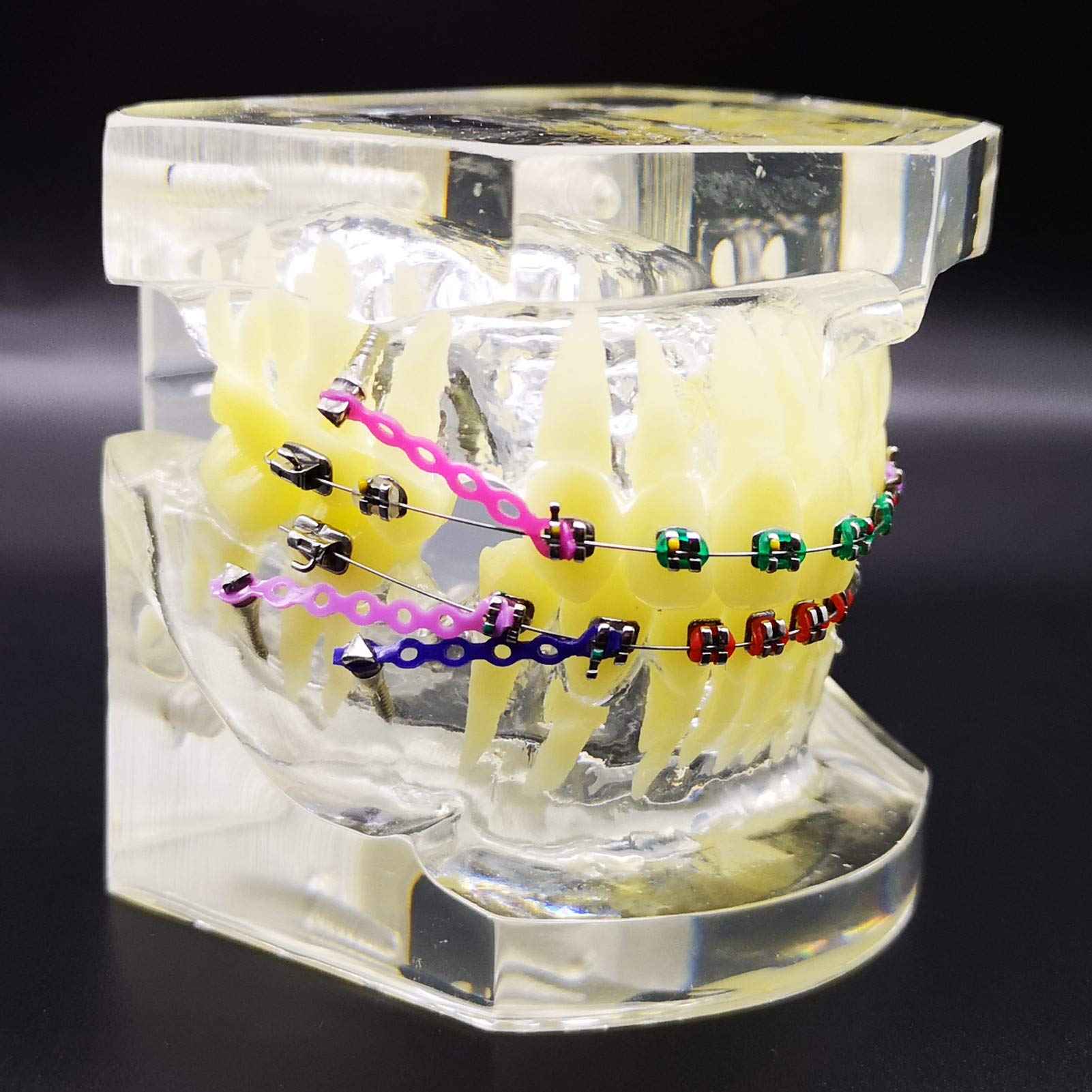Dental Typodont with Metal Brackets Orthodontic Teeth Model with Ligature Tie